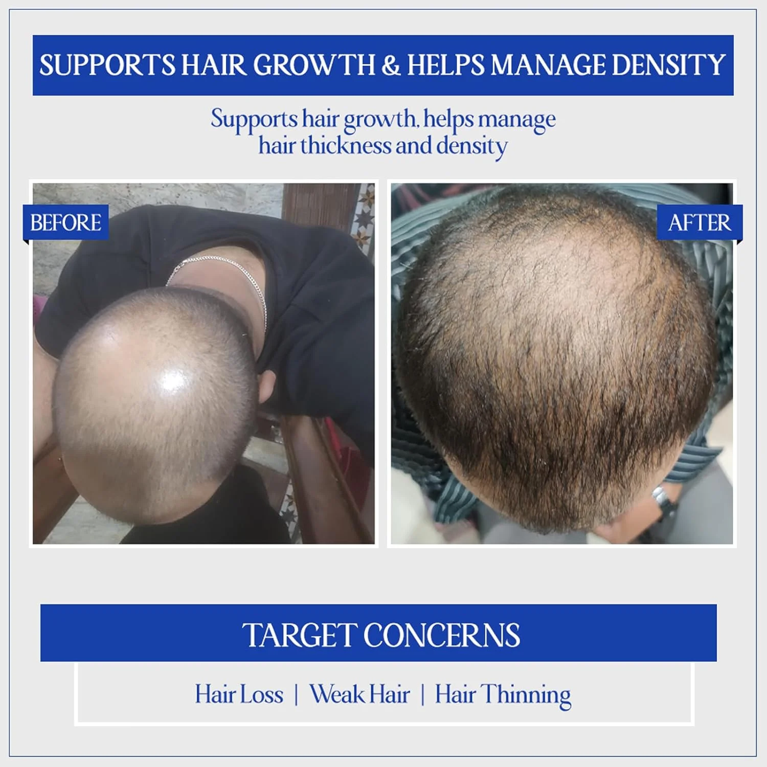 سرم رشد مو گیاهی TYC - TRUST YOUR CHOICE حاوی 3% Redensyl، 1% Procapil و 1% Capilia Longa | کنترل ریزش مو، نازک شدن مو و کم پشتی مو | تشویق رشد مو | PH 5.5، 140 گرم