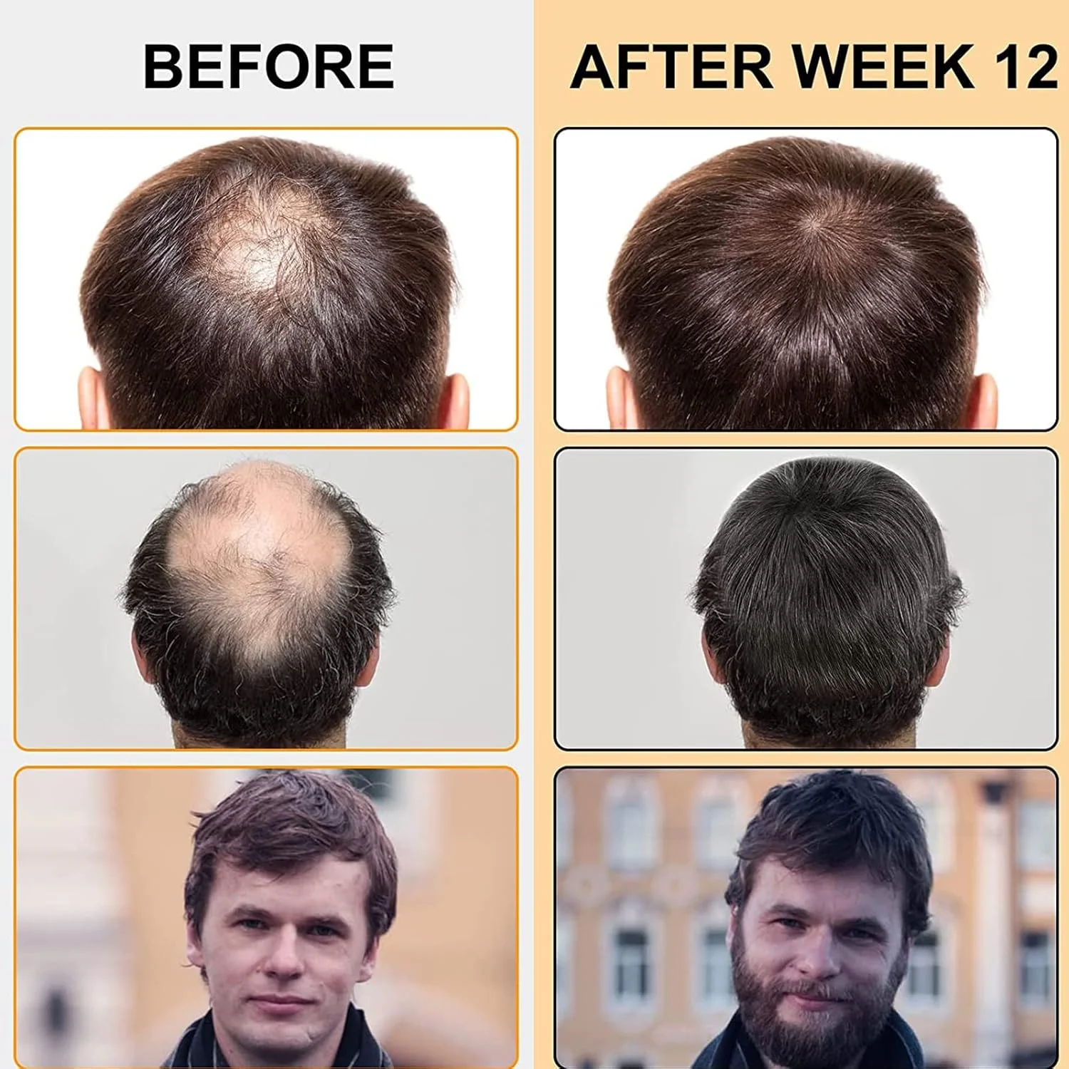 سرم رشد مجدد مو برای درمان ریزش مو آلوپسی، اسپری ملایم رشد مو، درمان رشد مجدد مو برای مردان و زنان، سرم رشد مجدد مو زنجبیلی برای ریزش مو، تقویت کننده و ضد ریزش مو