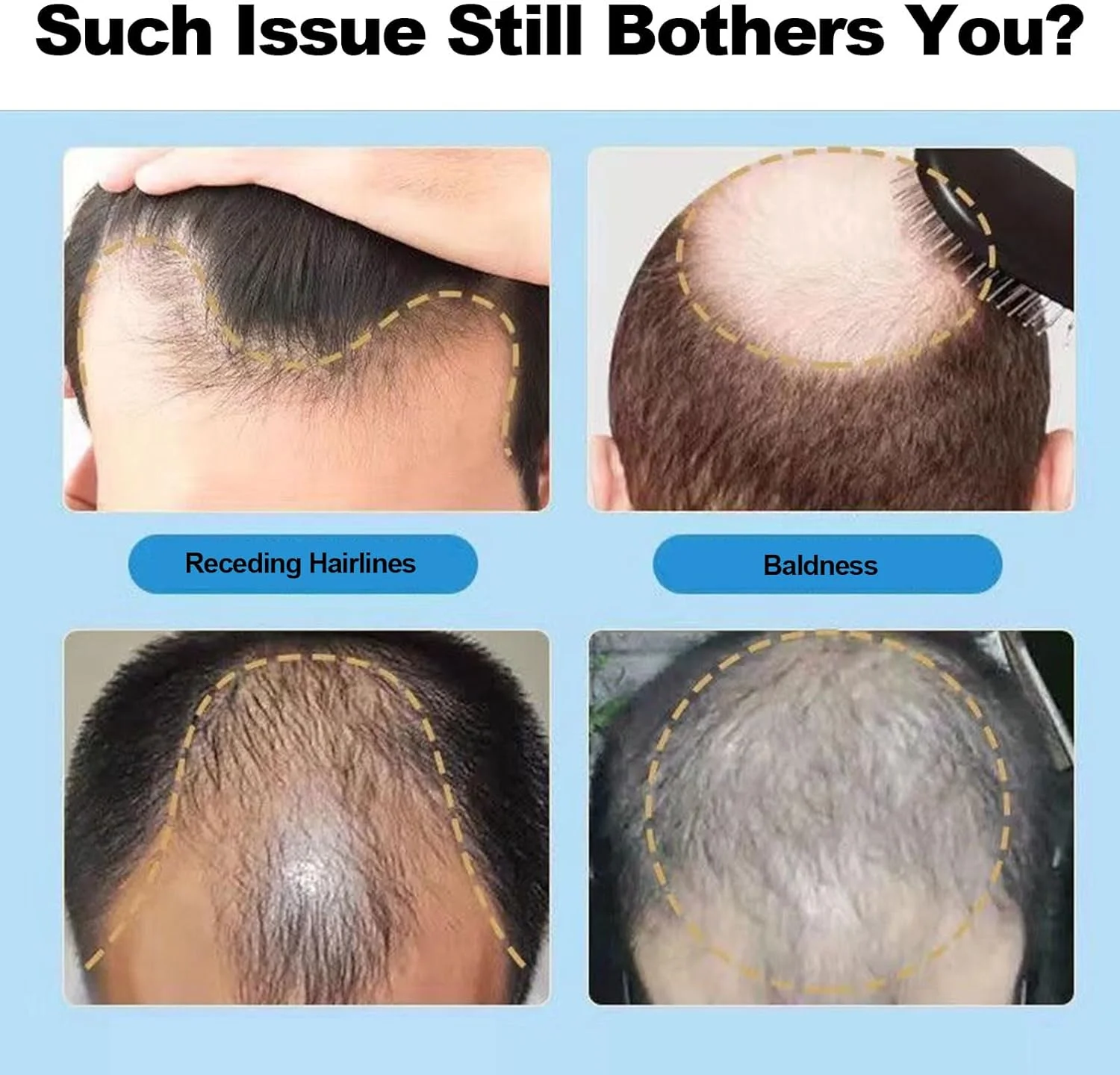 محلول ماینوکسیدیل 5% برای موی آقایان، سرم رشد موی ماینوکسیدیل برای رشد موی خانم ها، رشد ریش آقایان، درمان ریزش مو به همراه قطره چکان و ابزار ماساژ محلول ماینوکسیدیل 5% برای موی آقایان، سرم رشد موی ماینوکسیدیل برای رشد موی خانم ها، رشد ریش آقایان، درمان ریزش مو به همراه قطره چکان و ابزار ماساژ