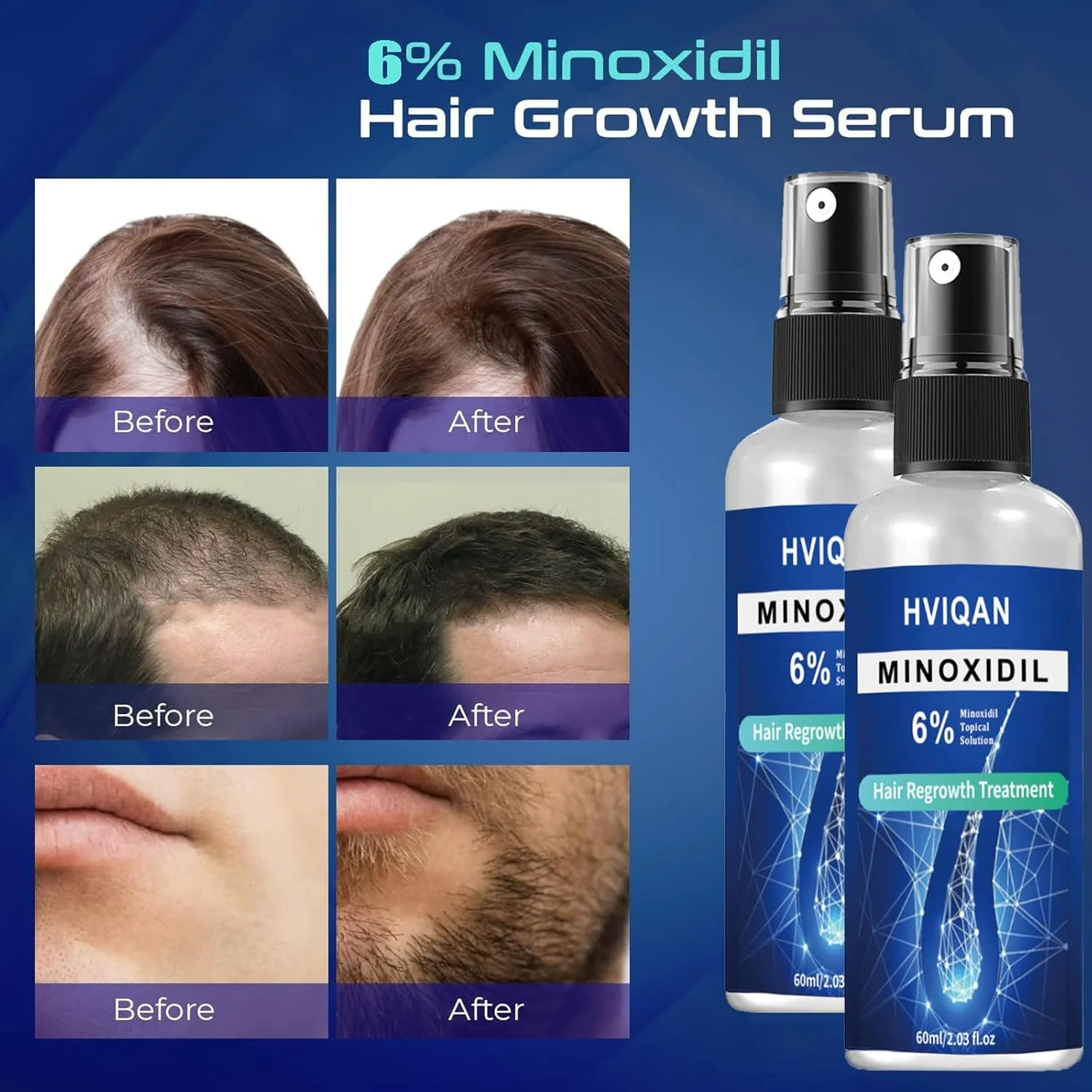محلول مینوکسیدیل 6% برای رشد مو آقایان و خانم ها، اسپری مینوکسیدیل برای رشد ریش، مبارزه با نازک شدن و ریزش مو، تقویت کننده درمان رشد مجدد مو