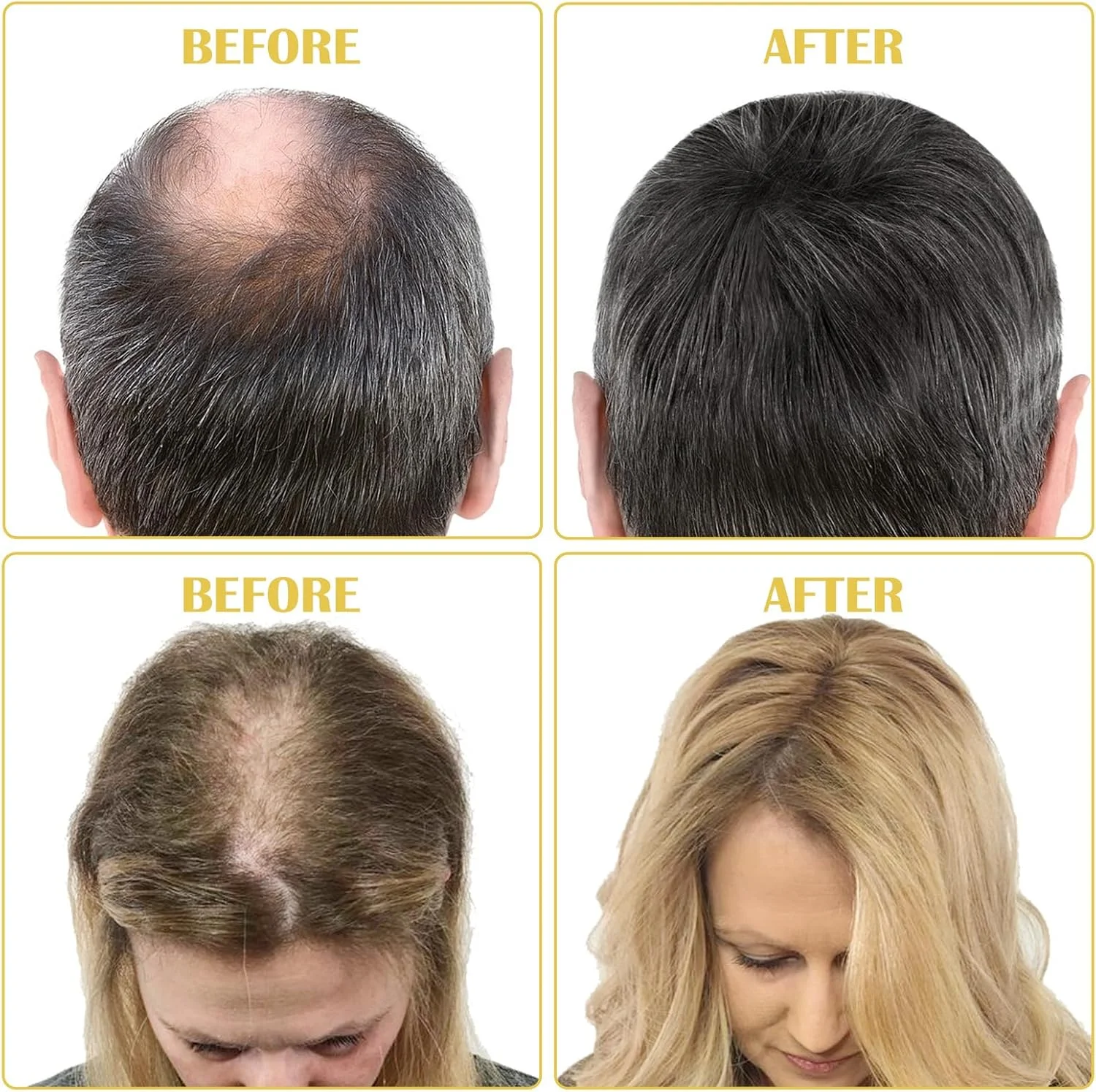 کیت سرم رشد مو حاوی 5% ماینوکسیدیل، درمان رشد مجدد مو برای ریزش و نازک شدن موی سر، حاوی بیوتین - 60 میلی لیتر، مناسب برای 1 ماه