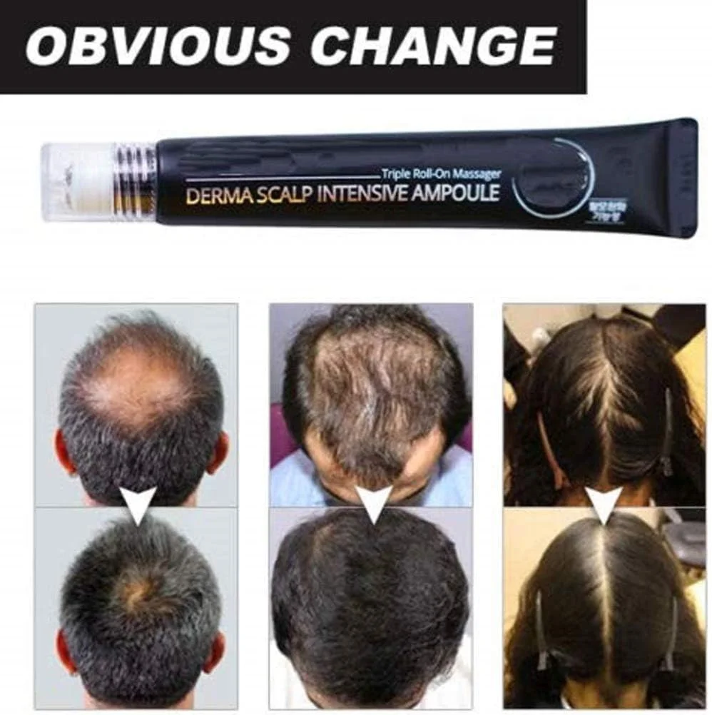 سرم ضد ریزش مو قوی Iwinna، سرم مراقبت از مو با ماساژور پوست سر 20 میلی لیتر، سرم رشد سریع مو رولی برای مردان و زنان