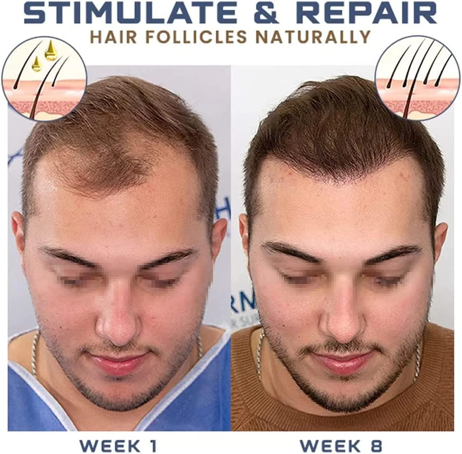 اسپری تقویت کننده مو ZOKU-HGP، اسپری محرک مو، سرم رشد مو Polygonum Multiflorum، روغن های ضروری زنجبیل برای رشد مو برای مردان و زنان 30 میلی لیتر (1 عدد)