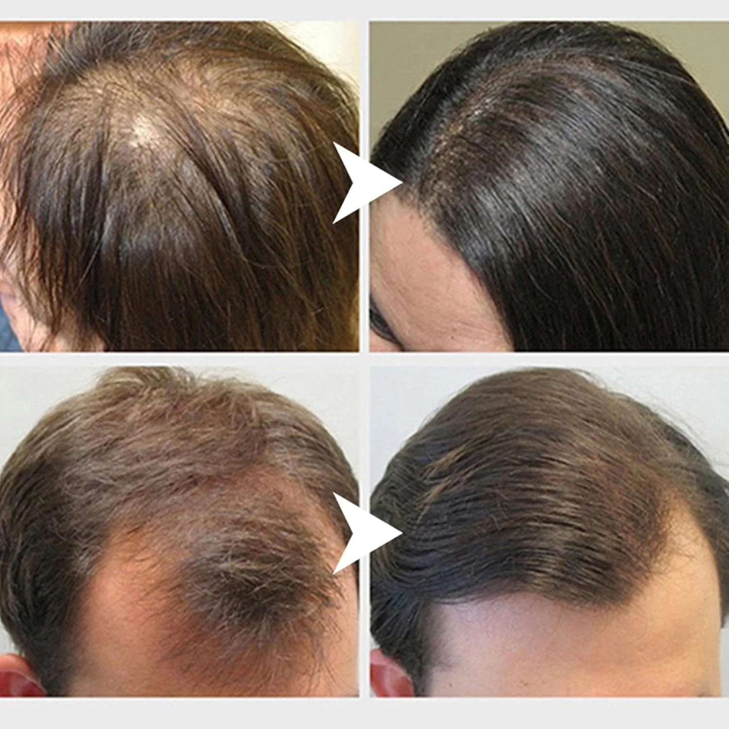 اسپری سرم رشد مو - اسپری ضخیم کننده مو برای موهای نازک - اسپری حداکثر کننده رشد مو، درمان های ریزش مو برای زنان و مردان اسپری سرم رشد مو - اسپری ضخیم کننده مو برای موهای نازک - اسپری حداکثر کننده رشد مو، درمان های ریزش مو برای زنان و مردان