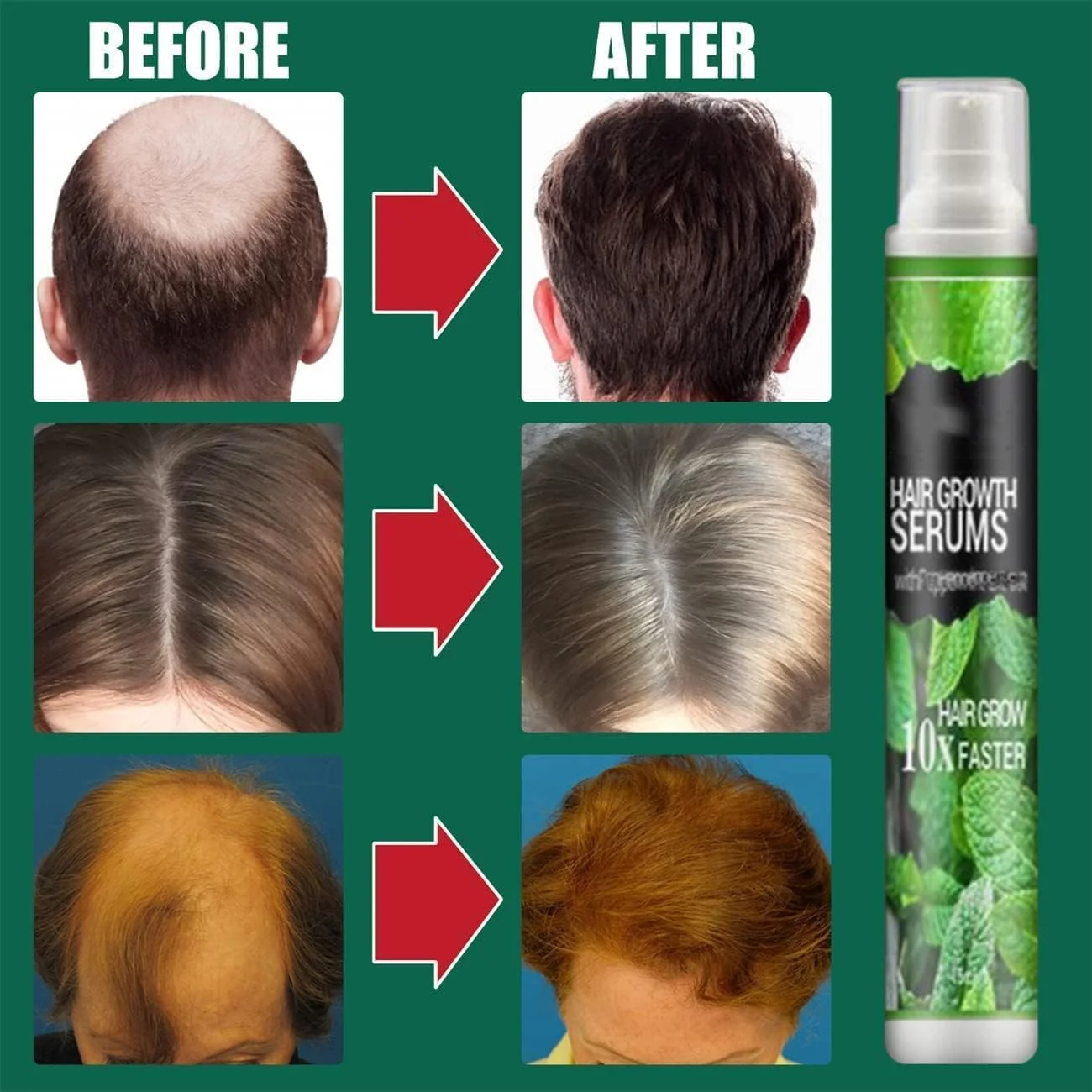 اسپری اسانس گیاهی رشد مو، جلوگیری از ریزش مو بعد از زایمان، اسپری اسانس گیاهی خط رویش مو، اسپری سرم رشد مو، روغن مو برای موهای قوی تر، ضخیم تر و رشد مو برای درمان ریزش مو (5 عدد) اسپری اسانس گیاهی رشد مو، جلوگیری از ریزش مو بعد از زایمان، اسپری اسانس گیاهی خط رویش مو، اسپری سرم رشد مو، روغن مو برای موهای قوی تر، ضخیم تر و رشد مو برای درمان ریزش مو (5 عدد)