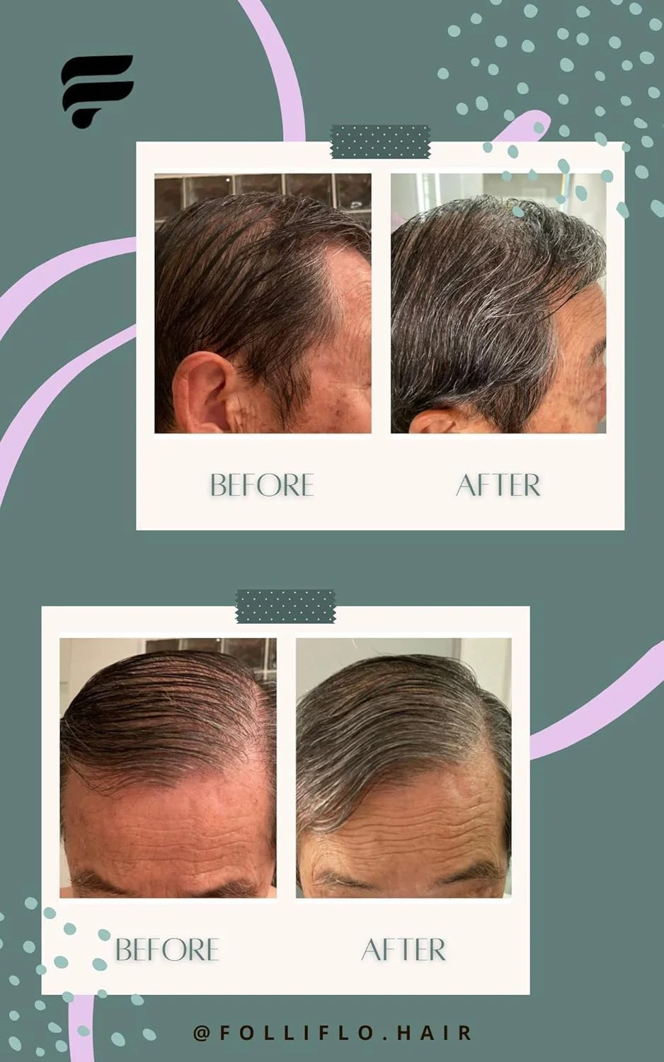 اسپری سرم حالت دهنده و تقویت کننده مو Folliflo by Cell Accel برای رشد مو اسپری سرم حالت دهنده و تقویت کننده مو Folliflo by Cell Accel برای رشد مو