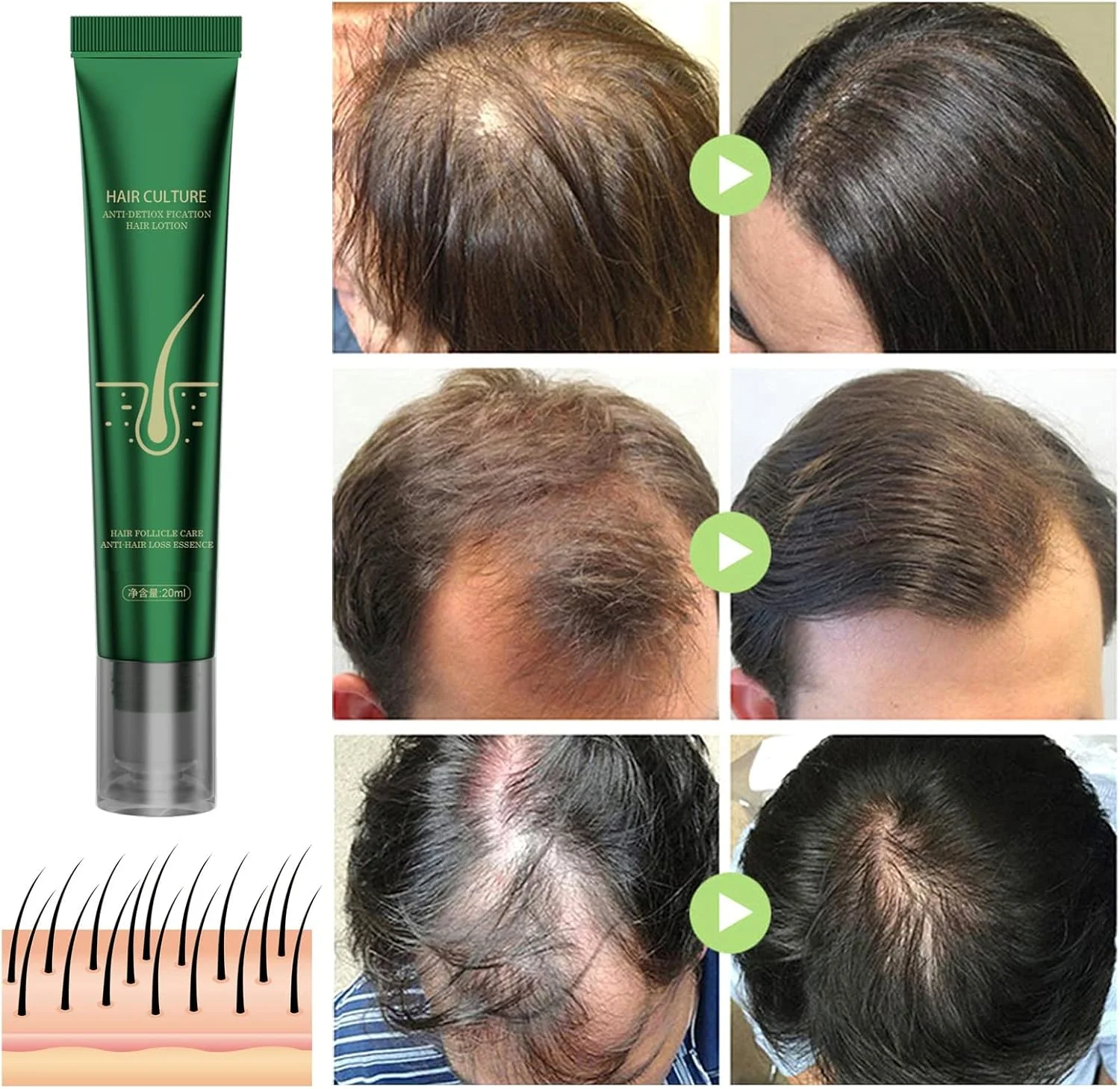 لوسیون سرم رشد مو زنجبیلی، اسانس رویش مجدد مو زنجبیلی، ماساژور سه غلتکی برای موهای ضخیم تر و قوی تر، درمان جلوگیری از ریزش مو (بسته 3 عددی 20 میلی لیتر) لوسیون سرم رشد مو زنجبیلی، اسانس رویش مجدد مو زنجبیلی، ماساژور سه غلتکی برای موهای ضخیم تر و قوی تر، درمان جلوگیری از ریزش مو (بسته 3 عددی 20 میلی لیتر)