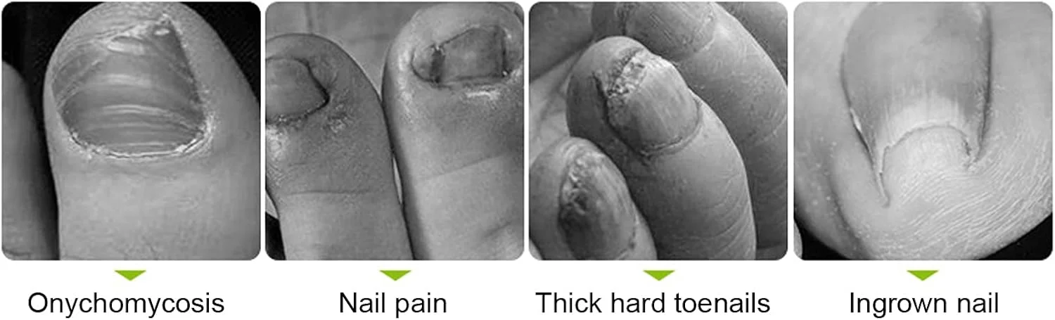 ابزار حذف کوتیکول، نیپر کوتیکول، انبر کوتیکول، ابزار پدیکور ناخن پا برای ناخن های فرورفته (نقره ای) ابزار حذف کوتیکول، نیپر کوتیکول، انبر کوتیکول، ابزار پدیکور ناخن پا برای ناخن های فرورفته (نقره ای)