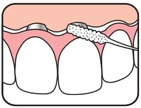 نخ دندان مخصوص بریج و ایمپلنت TePe