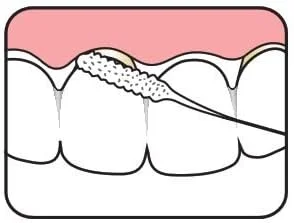 نخ دندان مخصوص بریج و ایمپلنت TePe
