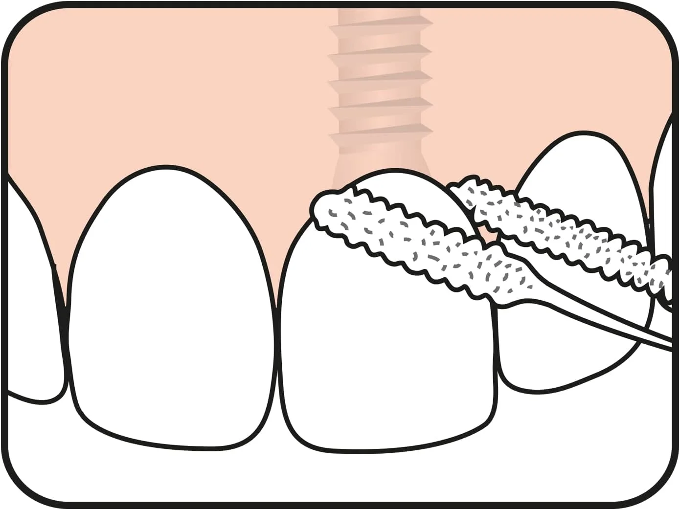نخ دندان مخصوص بریج و ایمپلنت تپه نخ دندان مخصوص بریج و ایمپلنت تپه