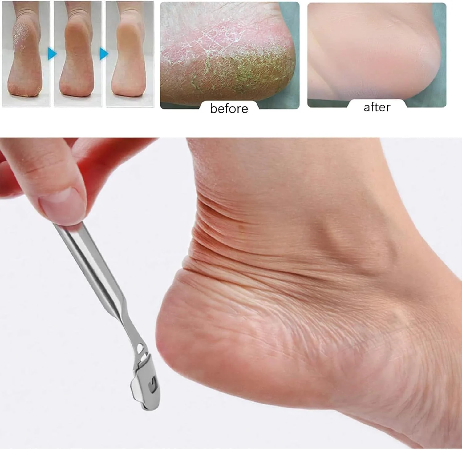 ست اسکرابر پا استیل ضد زنگ، کیت ابزار مراقبت از پا با قطعات قابل تعویض، از بین برنده پینه و کیت پدیکور، چاقوی پای 2 در 1 با تیغه ها، چنگال پوست مرده و دسته ارگونومیک برای از بین بردن پوست سخت