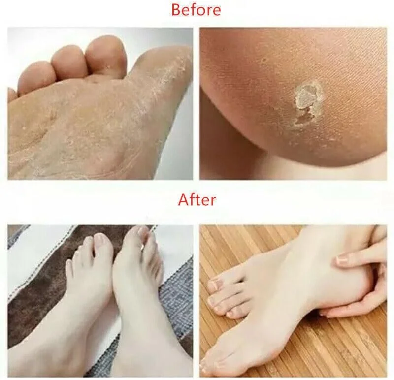 سوهان پدیکور پا، از بین برنده پینه، اسکراپر پا، رنده برای پاهای خشک و مرطوب