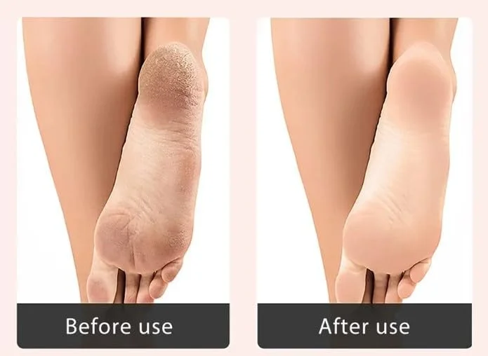 2 عدد سوهان پا از بین برنده پینه و پوست مرده، اسکرابر دو طرفه پا، ابزار پدیکور مراقبت از پا، مشکی-سبز