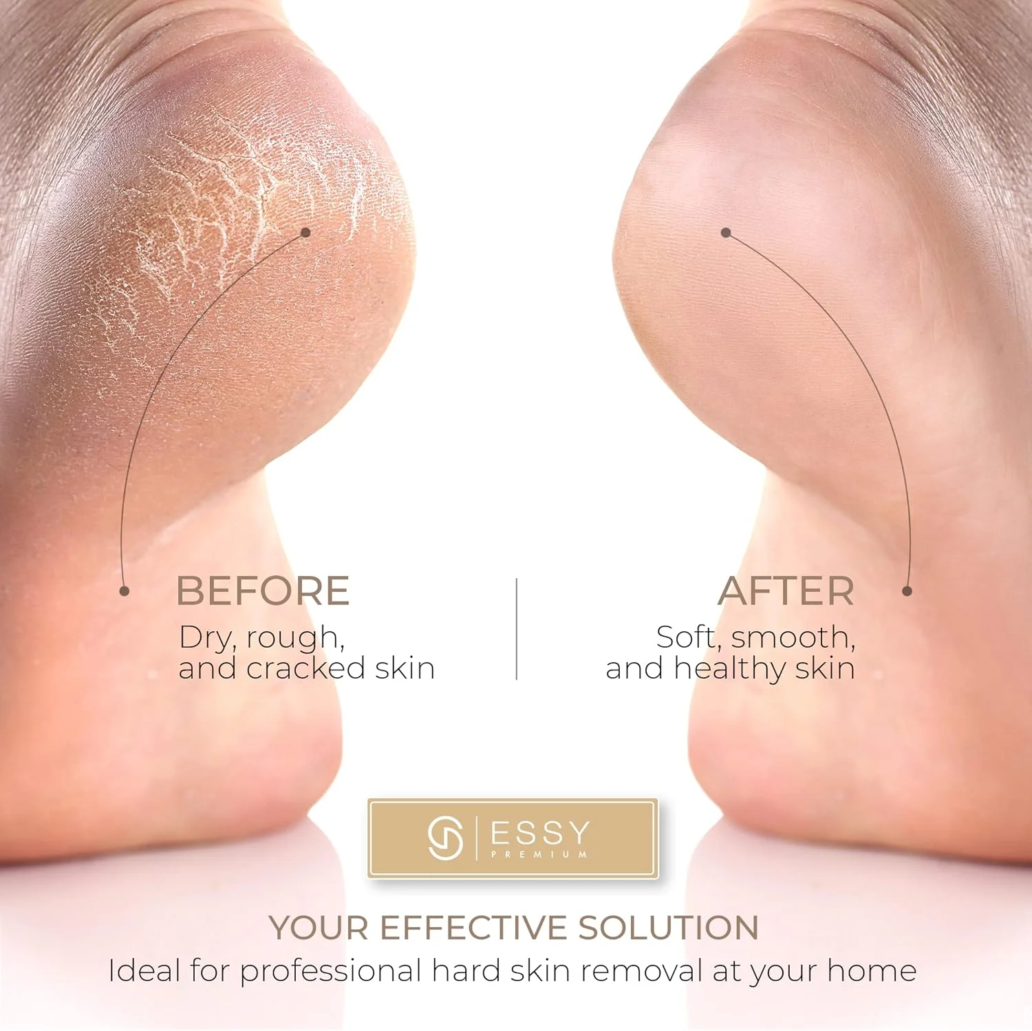 سوهان برقی پا Essy، پدیکور پا، از بین برنده پوست سخت، اسکرابر پا، از بین برنده پوست خشک و مرده، لایه بردار پینه، اسکرابر پا قابل شارژ با 5 غلتک تعویضی، مراقبت از پا، از بین برنده پوست