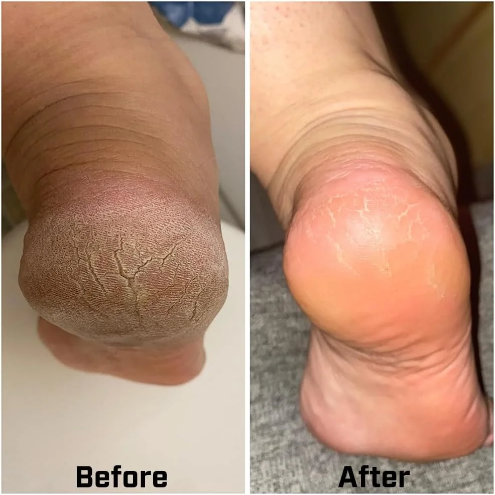 سوهان پا، فایل پا و از بین برنده پینه، ابزار پدیکور مراقبت از پا با سطح فلزی برای از بین بردن پوست سخت سوهان پا، فایل پا و از بین برنده پینه، ابزار پدیکور مراقبت از پا با سطح فلزی برای از بین بردن پوست سخت