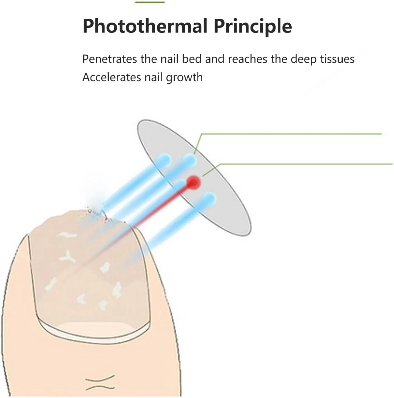 دستگاه درمان ناخن، دستگاه تسریع رشد بستر ناخن و پاکسازی ناخن 470 نانومتر، بسیار موثر برای ناخن های آسیب دیده پا