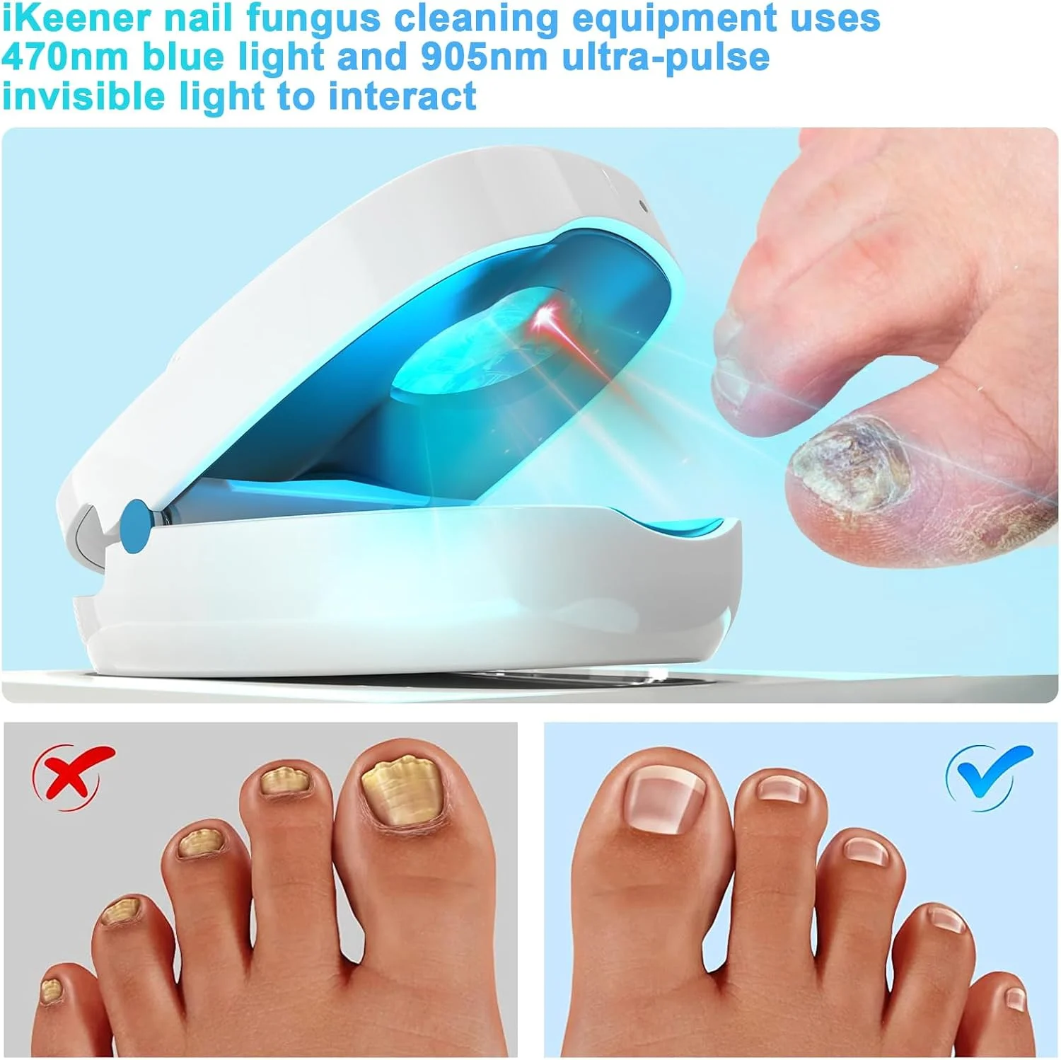 دستگاه درمان قارچ ناخن iKeener، محصولات مراقبت از ناخن و پا قابل شارژ، پاک کننده قابل حمل ناخن با لیزر درمانی سرد، تایید شده توسط FDA