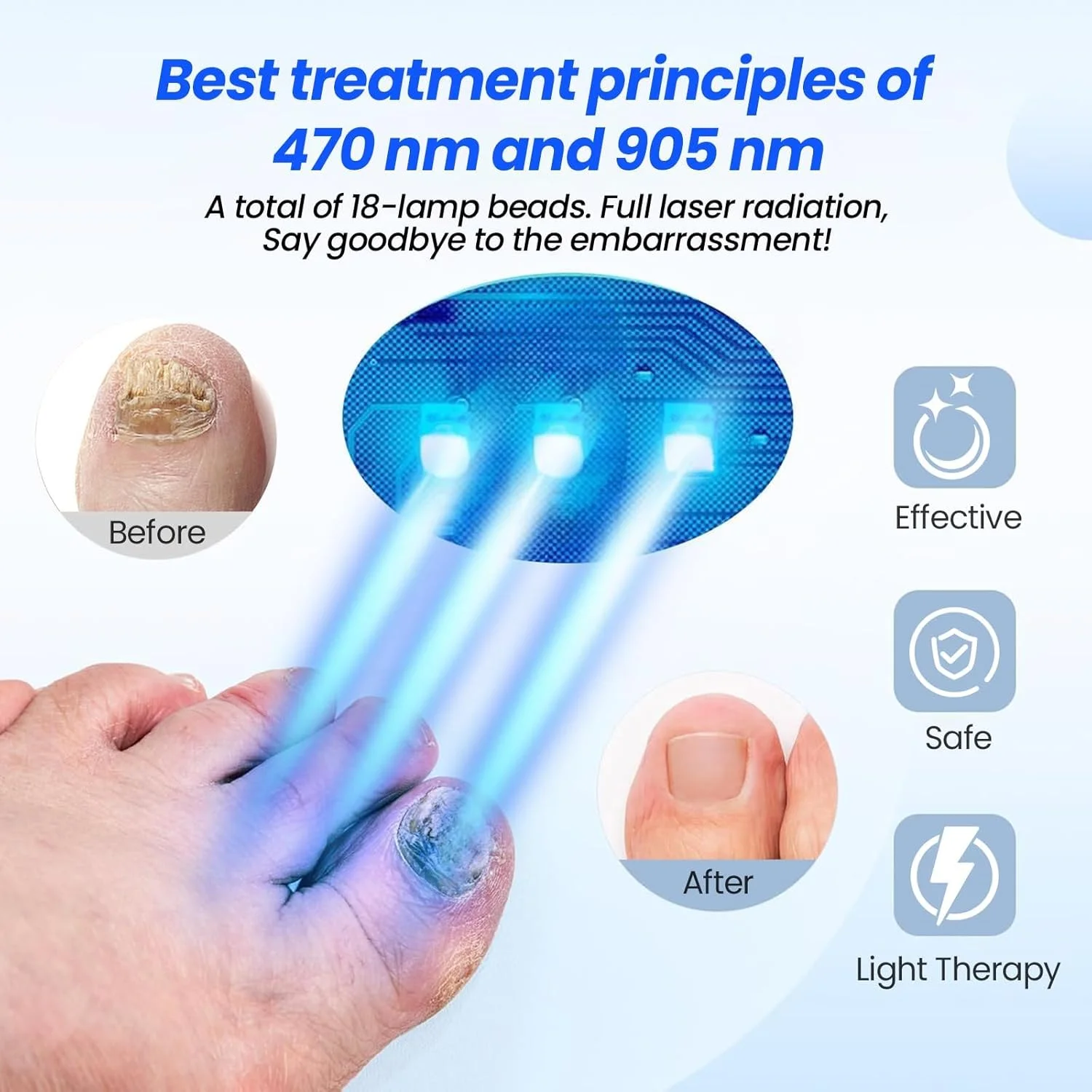 دستگاه درمان قارچ ناخن، دستگاه لیزر قارچ ناخن، درمان قابل تنظیم ناخن پا، بهبود قارچ، مناسب برای چندین ناخن دست و پا، ایمن و موثر برای استفاده در منزل