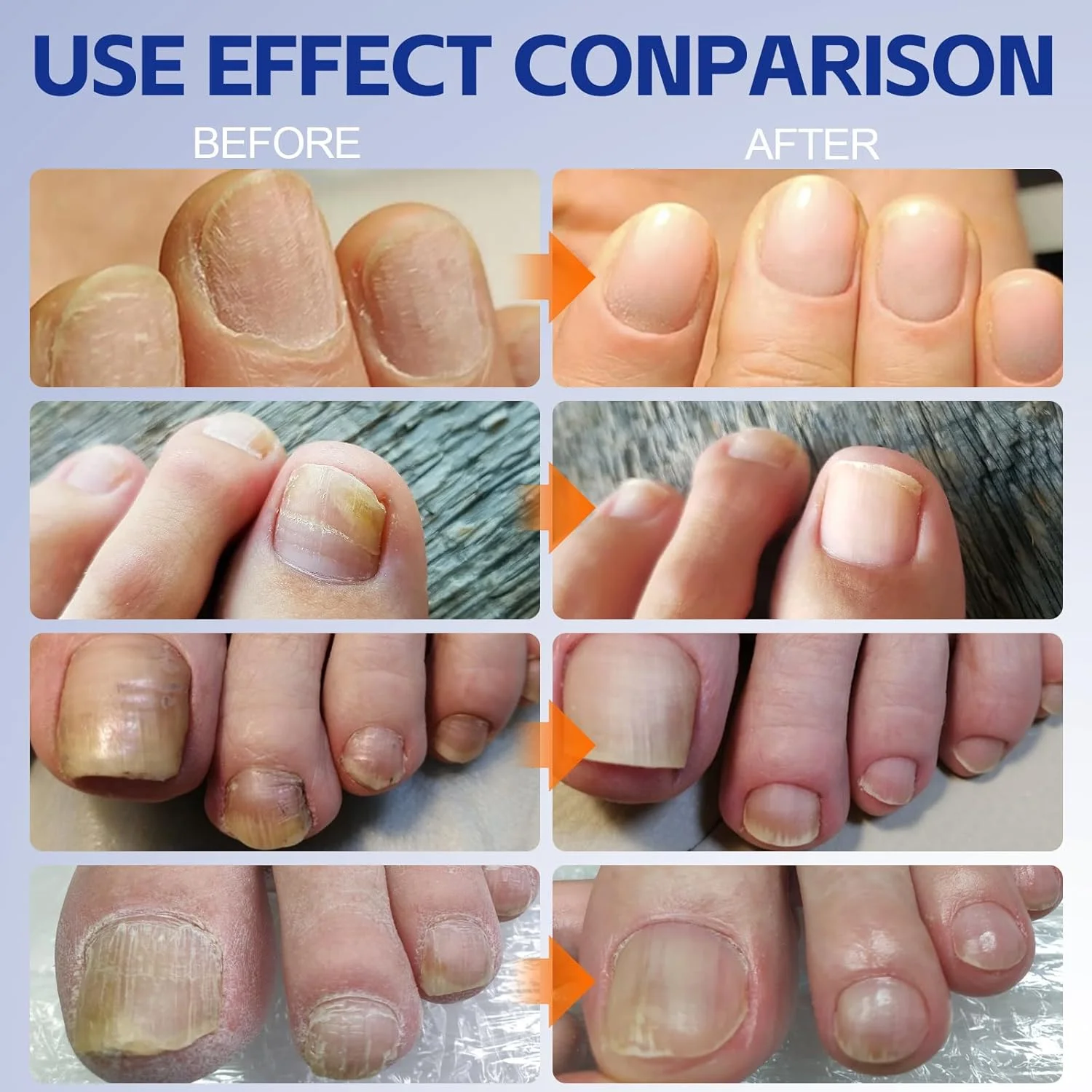 مایع درمان قارچ ناخن آپولیی 30 میلی لیتر، تقویت شده، مایع احیا و ترمیم قوی مراقبت از ناخن برای درمان ناخن های ضخیم، آسیب دیده و تغییر رنگ داده مایع درمان قارچ ناخن آپولیی 30 میلی لیتر، تقویت شده، مایع احیا و ترمیم قوی مراقبت از ناخن برای درمان ناخن های ضخیم، آسیب دیده و تغییر رنگ داده