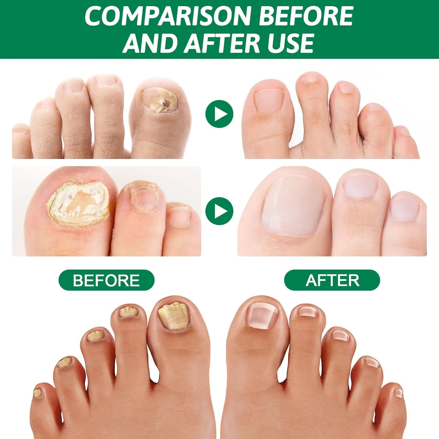 محلول درمان قارچ ناخن Azonee، ترمیم قارچ ناخن پا برای ضخیم شدن، تغییر رنگ زرد-قهوه ای و ترمیم ناخن، 30 میلی لیتر – درمان قوی قارچ ناخن پا و ناخن دست برای ناخن های سالم محلول درمان قارچ ناخن Azonee، ترمیم قارچ ناخن پا برای ضخیم شدن، تغییر رنگ زرد-قهوه ای و ترمیم ناخن، 30 میلی لیتر – درمان قوی قارچ ناخن پا و ناخن دست برای ناخن های سالم