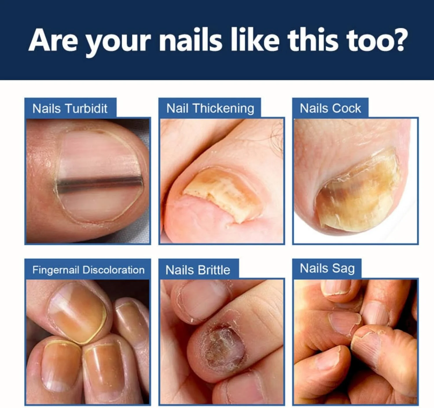 کرم درمان قارچ ناخن هونپولو - پماد ترمیم ناخن ضد قارچ 20 گرمی برای ناخن های ضخیم و ناخن های فرورفته - فرمول مرطوب کننده و مغذی برای مراقبت از دست و پا - تقویت کننده ترمیم ناخن کرم درمان قارچ ناخن هونپولو - پماد ترمیم ناخن ضد قارچ 20 گرمی برای ناخن های ضخیم و ناخن های فرورفته - فرمول مرطوب کننده و مغذی برای مراقبت از دست و پا - تقویت کننده ترمیم ناخن