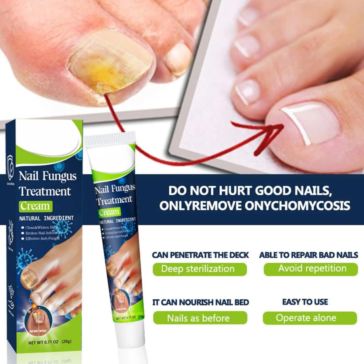 کرم درمان قارچ ناخن هونپولو - پماد ترمیم ناخن ضد قارچ 20 گرمی برای ناخن های ضخیم و ناخن های فرورفته - فرمول مرطوب کننده و مغذی برای مراقبت از دست و پا - تقویت کننده ترمیم ناخن کرم درمان قارچ ناخن هونپولو - پماد ترمیم ناخن ضد قارچ 20 گرمی برای ناخن های ضخیم و ناخن های فرورفته - فرمول مرطوب کننده و مغذی برای مراقبت از دست و پا - تقویت کننده ترمیم ناخن