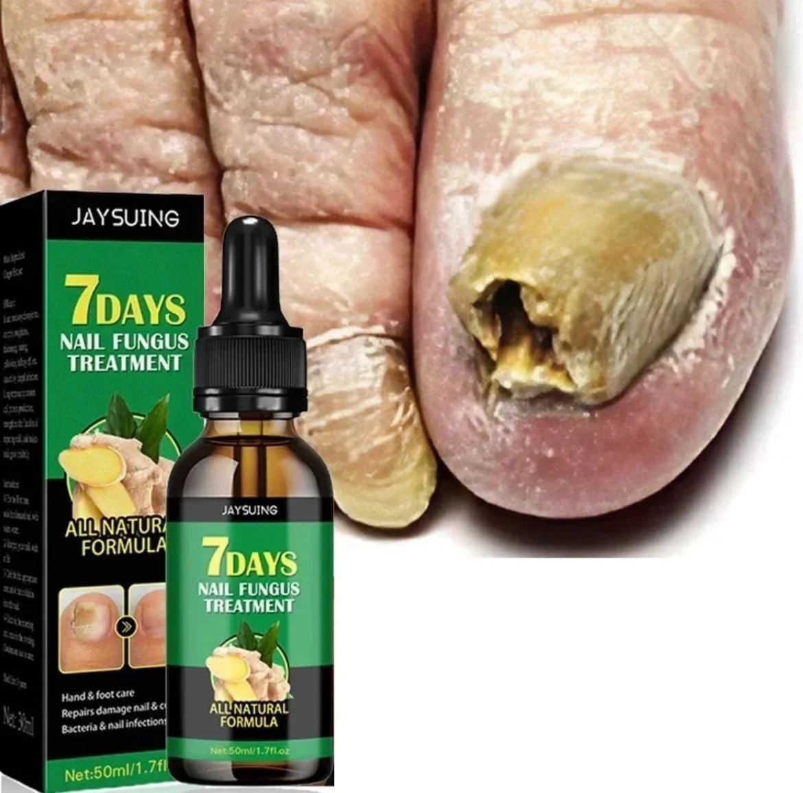 روغن اسانس درمان قارچ ناخن پا، سرم حذف قارچ ناخن انگشت پا، ترمیم کننده اونیکومیکوز، ژل مراقبت ضد عفونت روغن اسانس درمان قارچ ناخن پا، سرم حذف قارچ ناخن انگشت پا، ترمیم کننده اونیکومیکوز، ژل مراقبت ضد عفونت