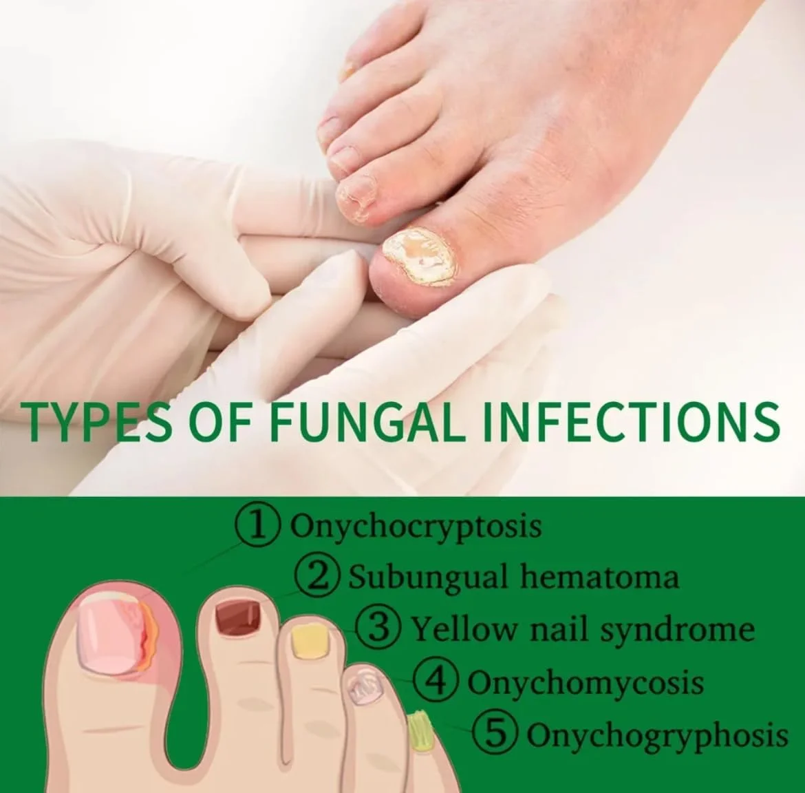 روغن اسانس درمان قارچ ناخن پا، سرم حذف قارچ ناخن انگشت پا، ترمیم کننده اونیکومیکوز، ژل مراقبت ضد عفونت