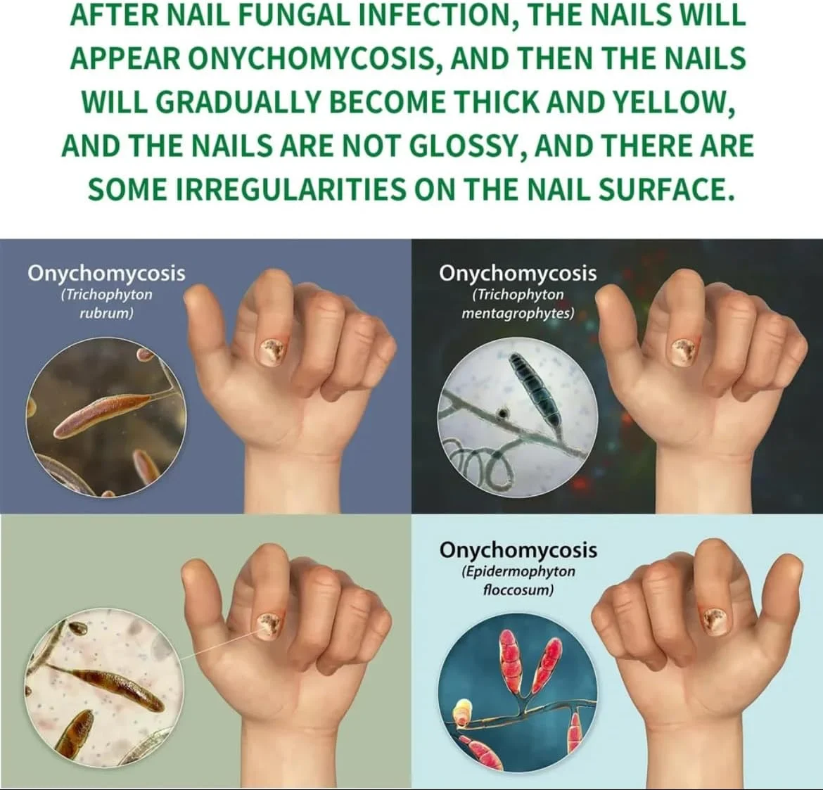 روغن اسانس درمان قارچ ناخن پا، سرم حذف قارچ ناخن انگشت پا، ترمیم کننده اونیکومیکوز، ژل مراقبت ضد عفونت