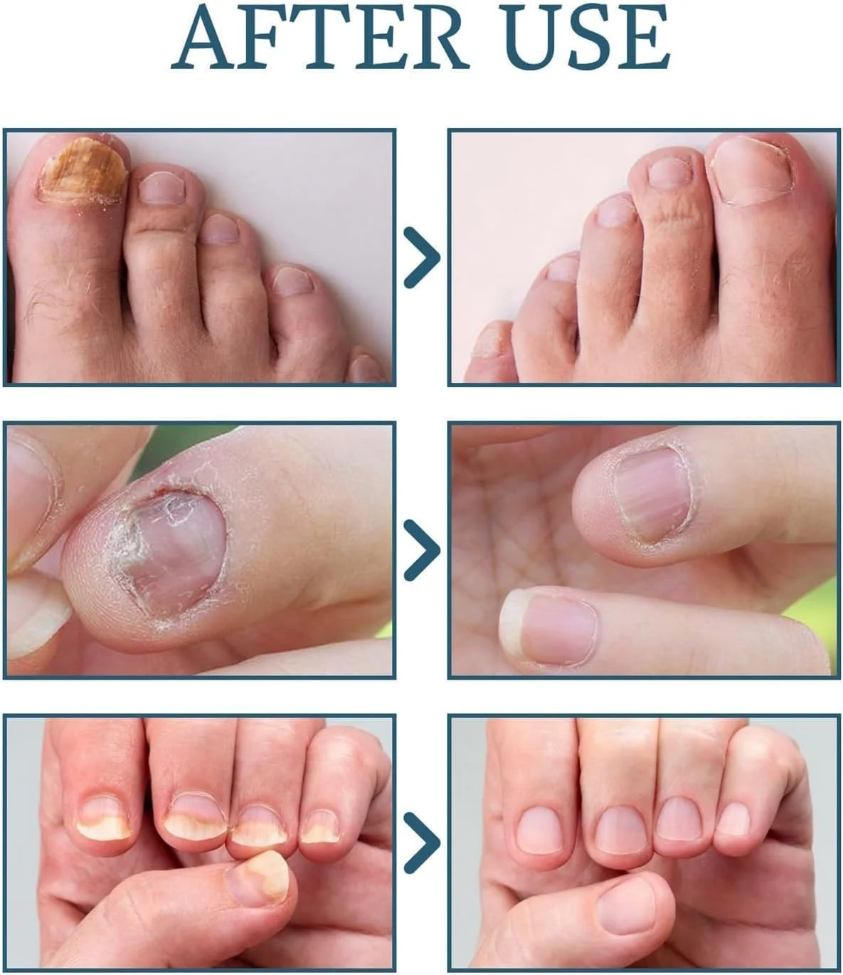 درمان قارچ ناخن LBOYLOVE®، درمان فوق العاده قوی قارچ ناخن برای ناخن پا و ناخن دست، ترمیم ضد قارچی ناخن برای ناخن های ضخیم، شکسته و تغییر رنگ داده، فرمول رشد سریع ناخن درمان قارچ ناخن LBOYLOVE®، درمان فوق العاده قوی قارچ ناخن برای ناخن پا و ناخن دست، ترمیم ضد قارچی ناخن برای ناخن های ضخیم، شکسته و تغییر رنگ داده، فرمول رشد سریع ناخن