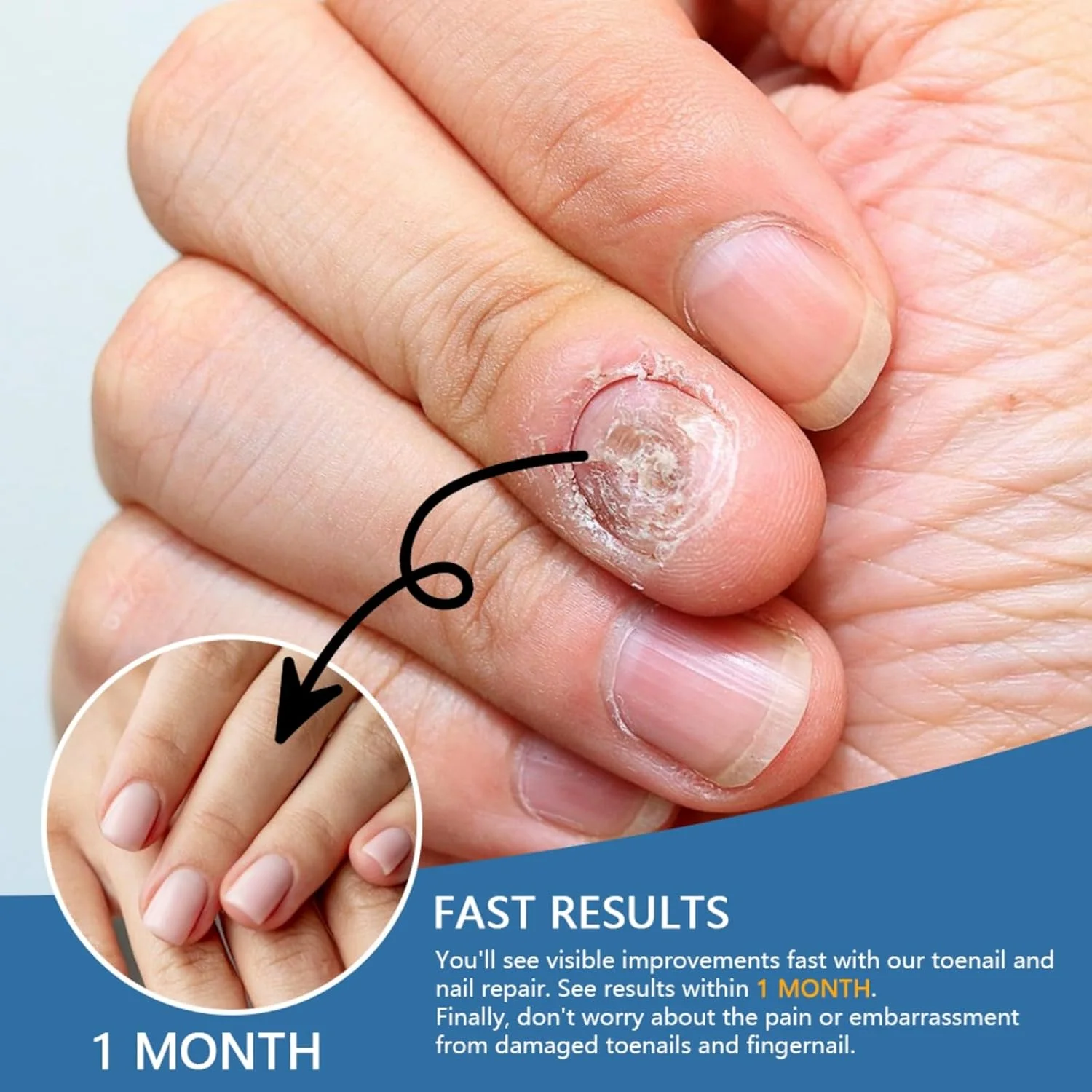 اسپری ضد قارچ ناخن JDLYEVER، 30 میلی لیتر - درمان موثر قارچ ناخن پا و ناخن دست - تسکین دهنده پای ورزشکاران، خوشبو کننده و از بین برنده بو - احیا کننده سلامت ناخن - جلوگیری از بازگشت قارچ اسپری ضد قارچ ناخن JDLYEVER، 30 میلی لیتر - درمان موثر قارچ ناخن پا و ناخن دست - تسکین دهنده پای ورزشکاران، خوشبو کننده و از بین برنده بو - احیا کننده سلامت ناخن - جلوگیری از بازگشت قارچ