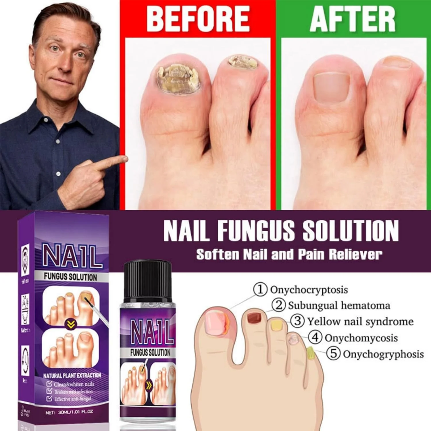 اسانس ترمیم کننده اونیکومیکوز JDLYEVER 30ml - محلول گیاهی برای عفونت های قارچی ناخن - فرمول غلیظ کننده و صاف کننده - نفوذ عمیق - جلوگیری از عفونت های قارچی دست و پا