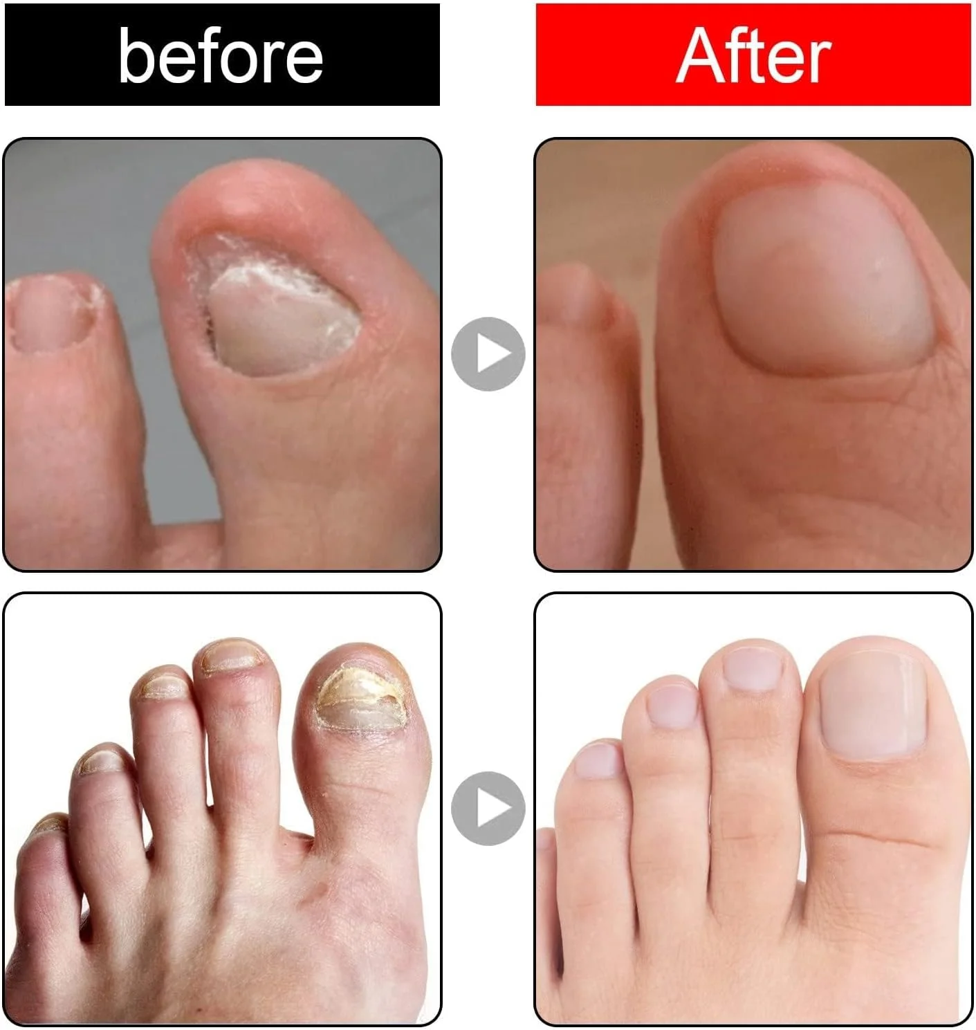 محلول درمان ناخن فرورفته ایکیپ (10 میلی لیتر) - قطره های بسیار قوی اصلاح ناخن برای ناخن های آسیب دیده و روغن کوتیکول با فرمول رشد محلول درمان ناخن فرورفته ایکیپ (10 میلی لیتر) - قطره های بسیار قوی اصلاح ناخن برای ناخن های آسیب دیده و روغن کوتیکول با فرمول رشد