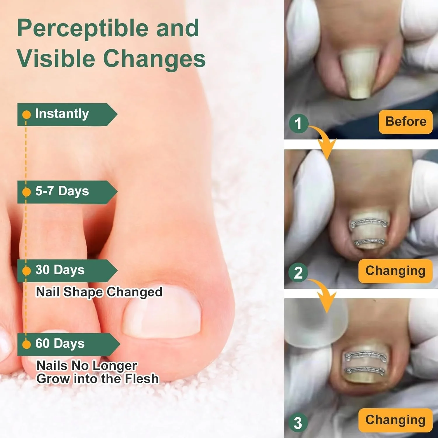 اصلاح کننده ناخن فرورفته یانکسیفی، درمان ناخن فرورفته، صاف کننده خمیده، کیت رفع درد ابزار بزرگ (1.4 سانتی متر، 1.67 سانتی متر)