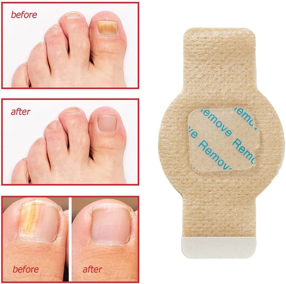 کیت درمان ناخن 3 در 1 PORUPAEL - 21 پد درمان ناخن + 10 نوار صاف کننده ناخن + 1 ابزار لیفتر ناخن پا برای تسکین ناخن های فرورفته و آسیب دیده