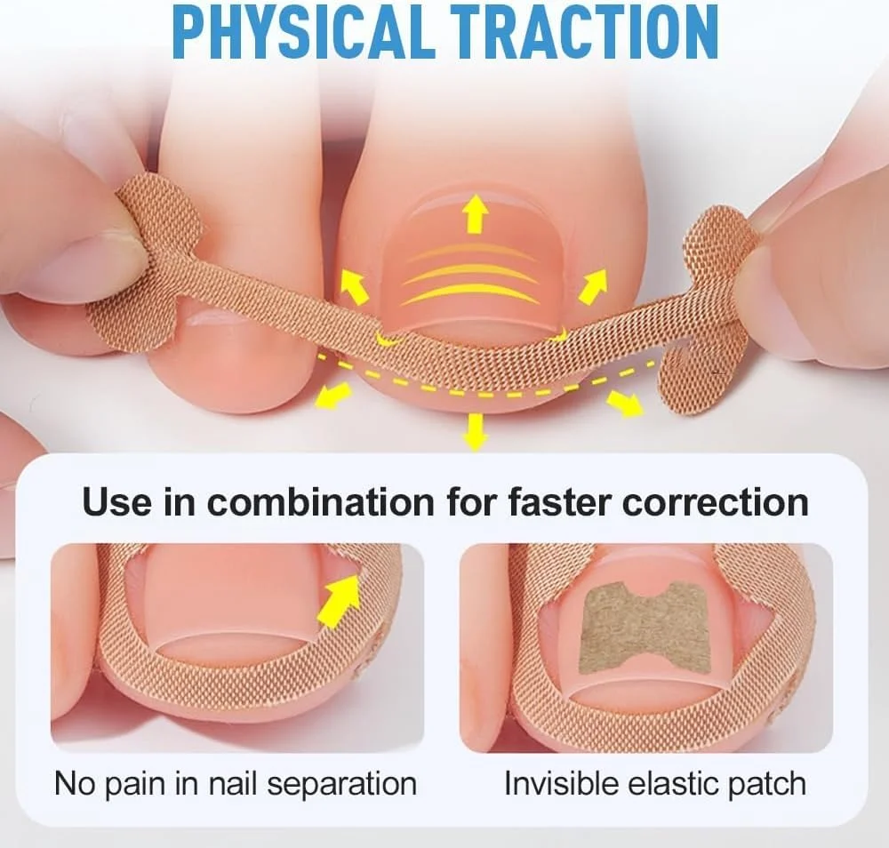 مجموعه اصلاح کننده ناخن پا فرورفته PINKE، با نوارهای تنفسی ناخن پا فرورفته، پد اصلاح کننده ناخن های منحنی، سوهان بدون درد و ابزارهای پدیکور بالابر برای اصلاح ناخن پا مردانه و زنانه