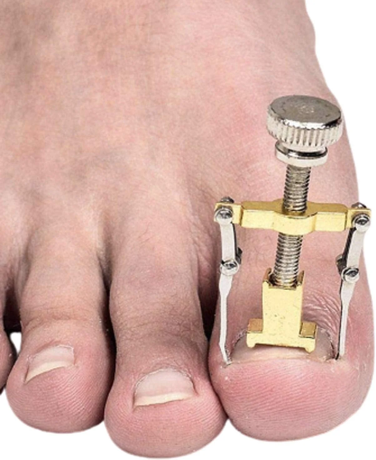 ابزار اصلاح ناخن پا فرورفته گلمزا برای درمان ایمن و موثر ابزار اصلاح ناخن پا فرورفته گلمزا برای درمان ایمن و موثر