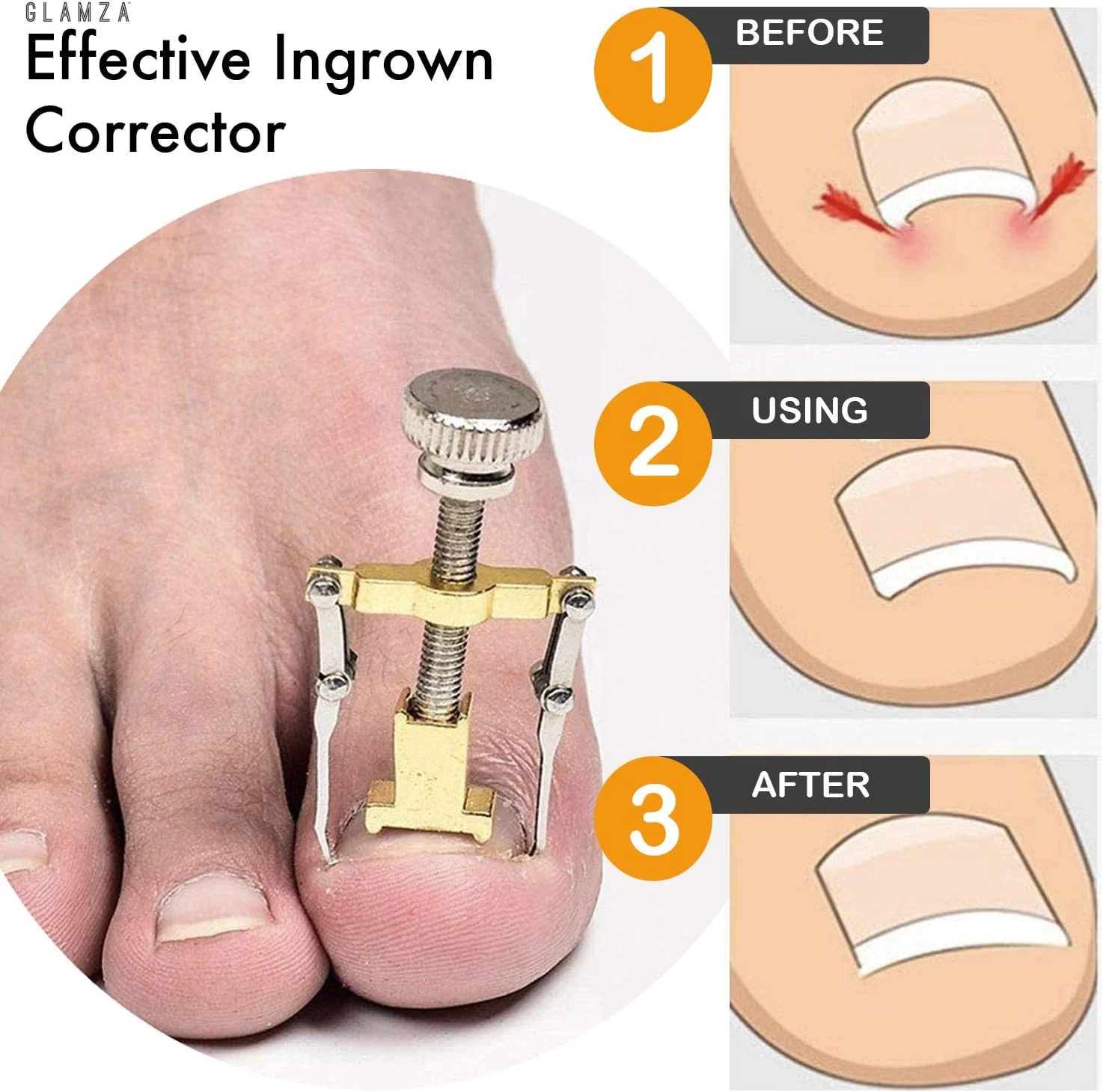 ابزار اصلاح ناخن پا فرورفته گلمزا برای درمان ایمن و موثر ابزار اصلاح ناخن پا فرورفته گلمزا برای درمان ایمن و موثر