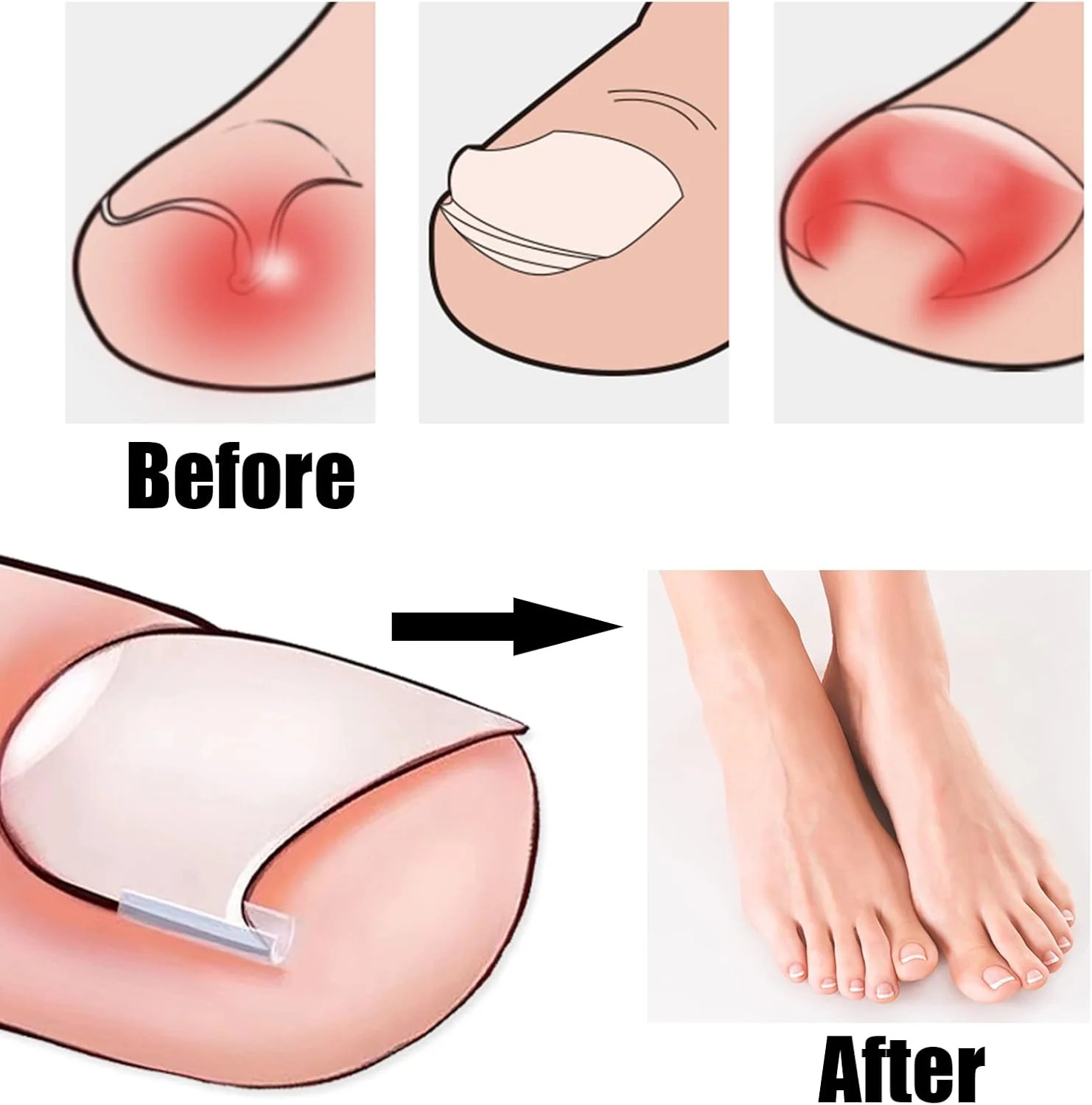 کیت 52 عددی نوار اصلاح ناخن پا فرورفته، پد اصلاح ناخن، صاف کننده ناخن پا خمیده به همراه ابزار صاف کردن ناخن و ناخن گیر برای زنان و مردان، مراقبت از پا کیت 52 عددی نوار اصلاح ناخن پا فرورفته، پد اصلاح ناخن، صاف کننده ناخن پا خمیده به همراه ابزار صاف کردن ناخن و ناخن گیر برای زنان و مردان، مراقبت از پا