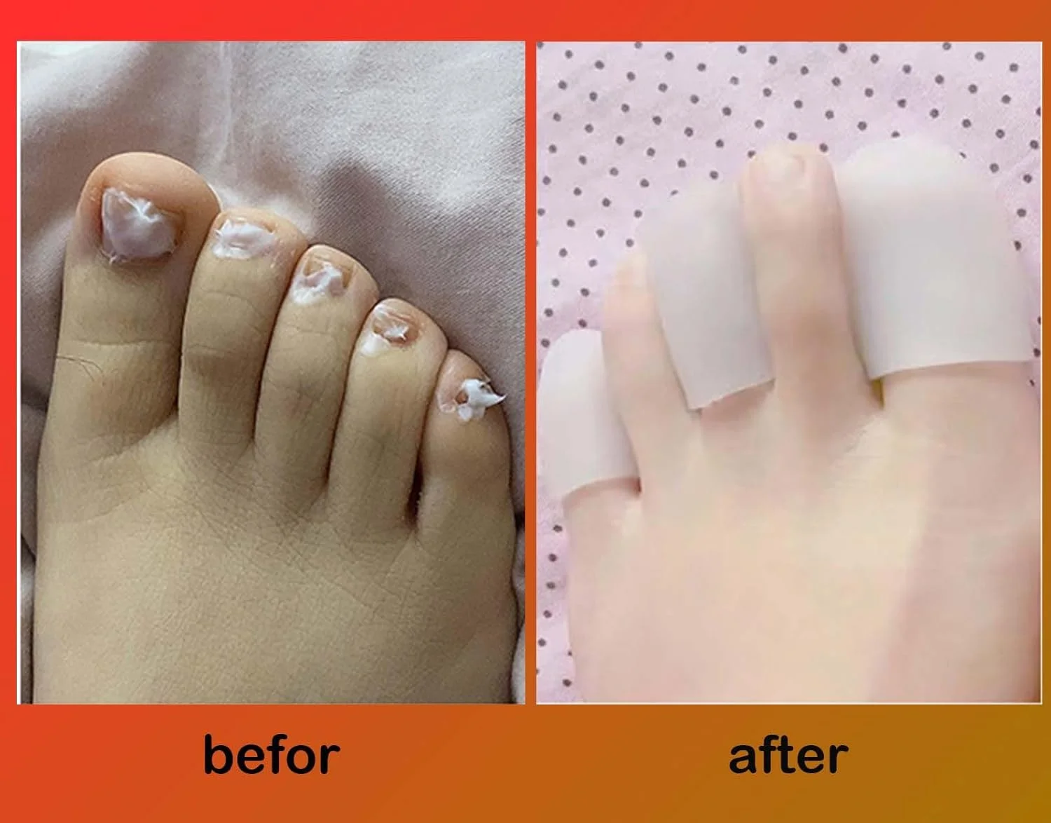 کیت موثر درمان ناخن – پوشش برای جلوگیری از گسترش، محافظت از لباس، کفش و تخت. نتایج سریع و ماندگار