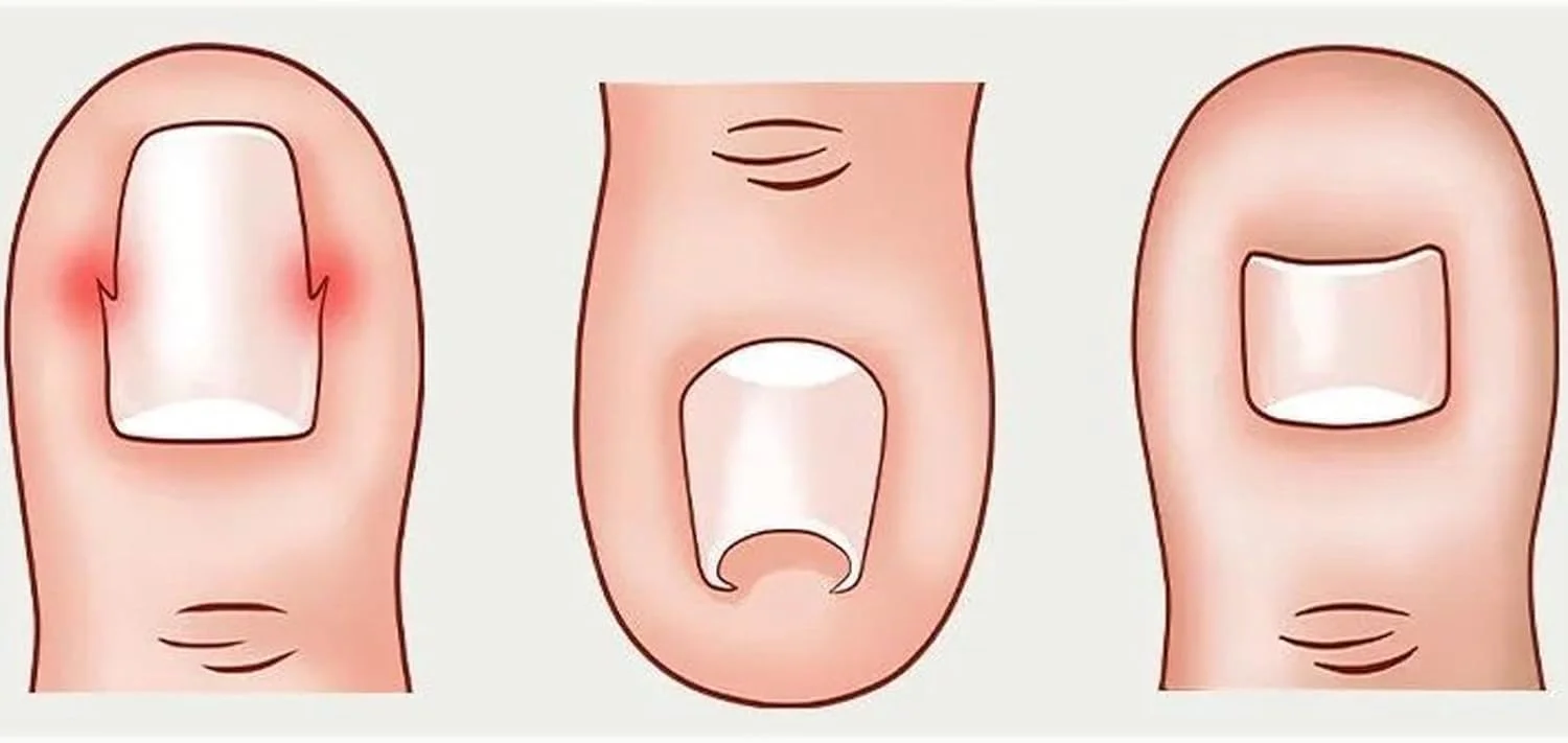 مجموعه اصلاح کننده ناخن پا فرو رفته، 60 عددی، کیت حرفه ای و بدون درد رفع ناخن پا فرو رفته، لیفتر ناخن پا برای آقایان و بانوان، مانیکور و مراقبت، تسکین درد ناخن پا مجموعه اصلاح کننده ناخن پا فرو رفته، 60 عددی، کیت حرفه ای و بدون درد رفع ناخن پا فرو رفته، لیفتر ناخن پا برای آقایان و بانوان، مانیکور و مراقبت، تسکین درد ناخن پا