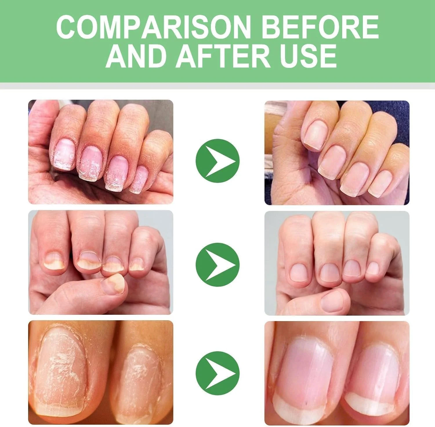 سرم ترمیم ناخن آزونی برای ناخن های آسیب دیده، درمان تقویت کننده و رشد 7 روزه، تقویت کننده ناخن برای ناخن های آسیب دیده، سخت کننده ناخن، درمان رشد ناخن پا، محلول ترمیم ناخن (20 میلی لیتر)