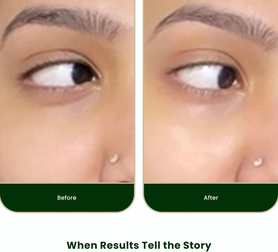 روغن ترمیم کننده دور چشم SKOG | حاوی روغن سیب زمینی و ویتامین E | کاهش تیرگی و پف | احیا کننده پوست دور چشم مناسب انواع پوست (10 میلی لیتر، بسته 1 عددی) روغن ترمیم کننده دور چشم SKOG | حاوی روغن سیب زمینی و ویتامین E | کاهش تیرگی و پف | احیا کننده پوست دور چشم مناسب انواع پوست (10 میلی لیتر، بسته 1 عددی)