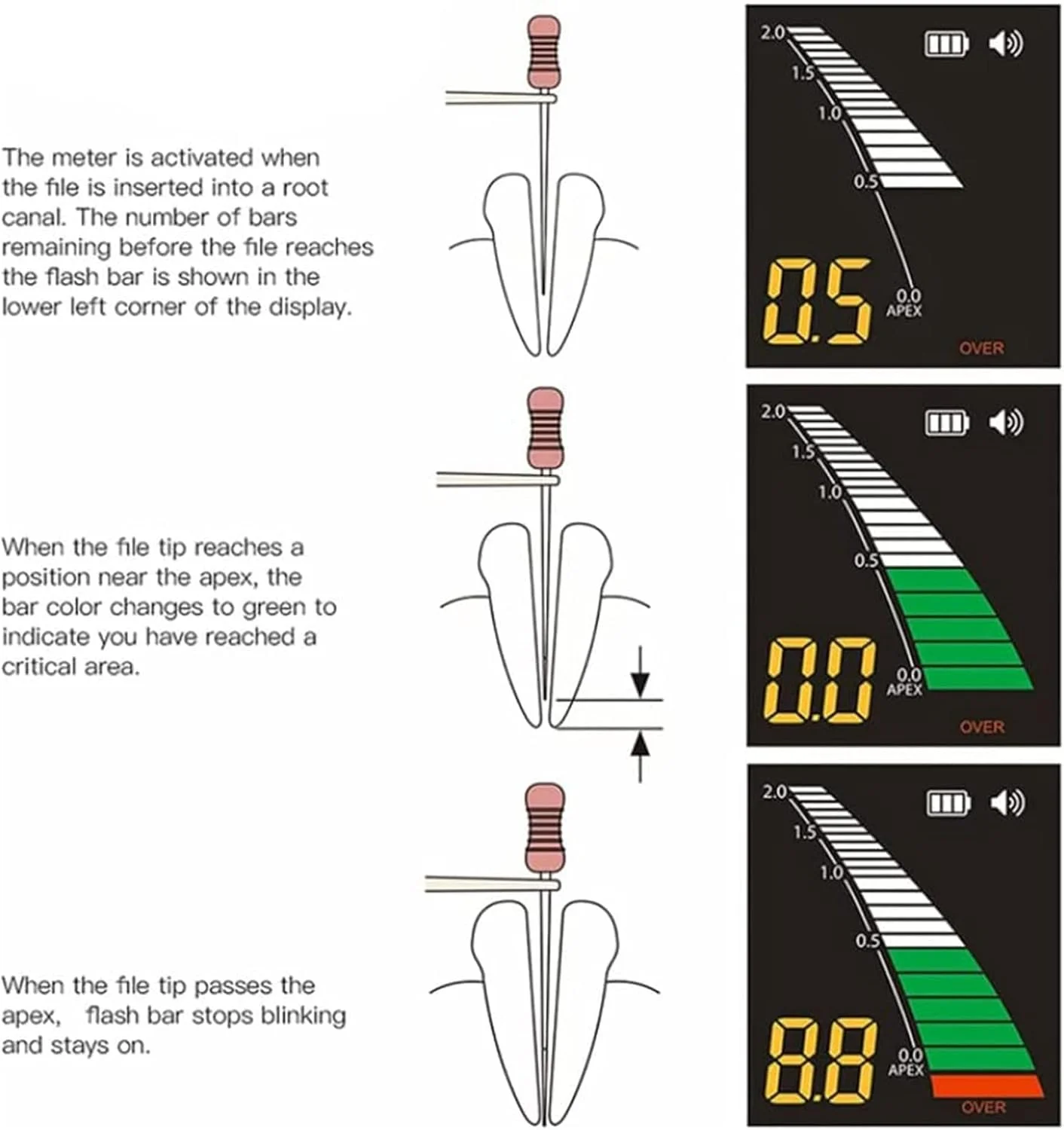 دستگاه تعیین موقعیت اپکس دندان، ابزار اندازه گیری کانال ریشه با دقت بالا و صفحه نمایش 3.2 اینچی LCD، ابزار اندازه گیری اپیکال دندان برای درمان اندودنتیک دستگاه تعیین موقعیت اپکس دندان، ابزار اندازه گیری کانال ریشه با دقت بالا و صفحه نمایش 3.2 اینچی LCD، ابزار اندازه گیری اپیکال دندان برای درمان اندودنتیک