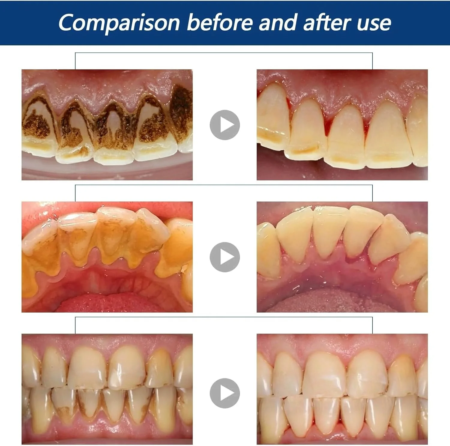 اسپری پاک کننده جرم دندان، از بین برنده طولانی مدت و طراوت بخش جرم دندان - پاک کننده پلاک دندان، اسپری سفید کننده دندان، اسپری ضد بوی بد دهان (30 میلی لیتر) اسپری پاک کننده جرم دندان، از بین برنده طولانی مدت و طراوت بخش جرم دندان - پاک کننده پلاک دندان، اسپری سفید کننده دندان، اسپری ضد بوی بد دهان (30 میلی لیتر)