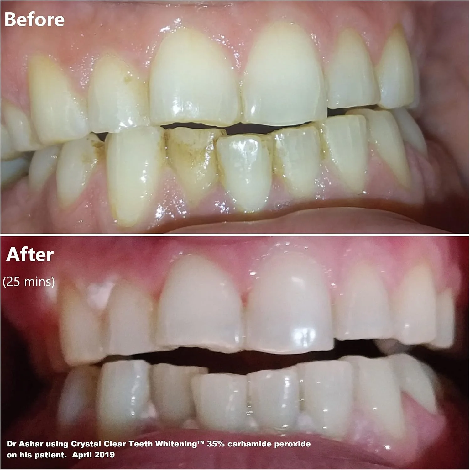 کیت سفید کننده دندان کریستالی، مورد تایید دندانپزشکان ایالات متحده آمریکا، ژل سفید کننده دندان با نور LED، 30 میلی لیتر ژل و تری