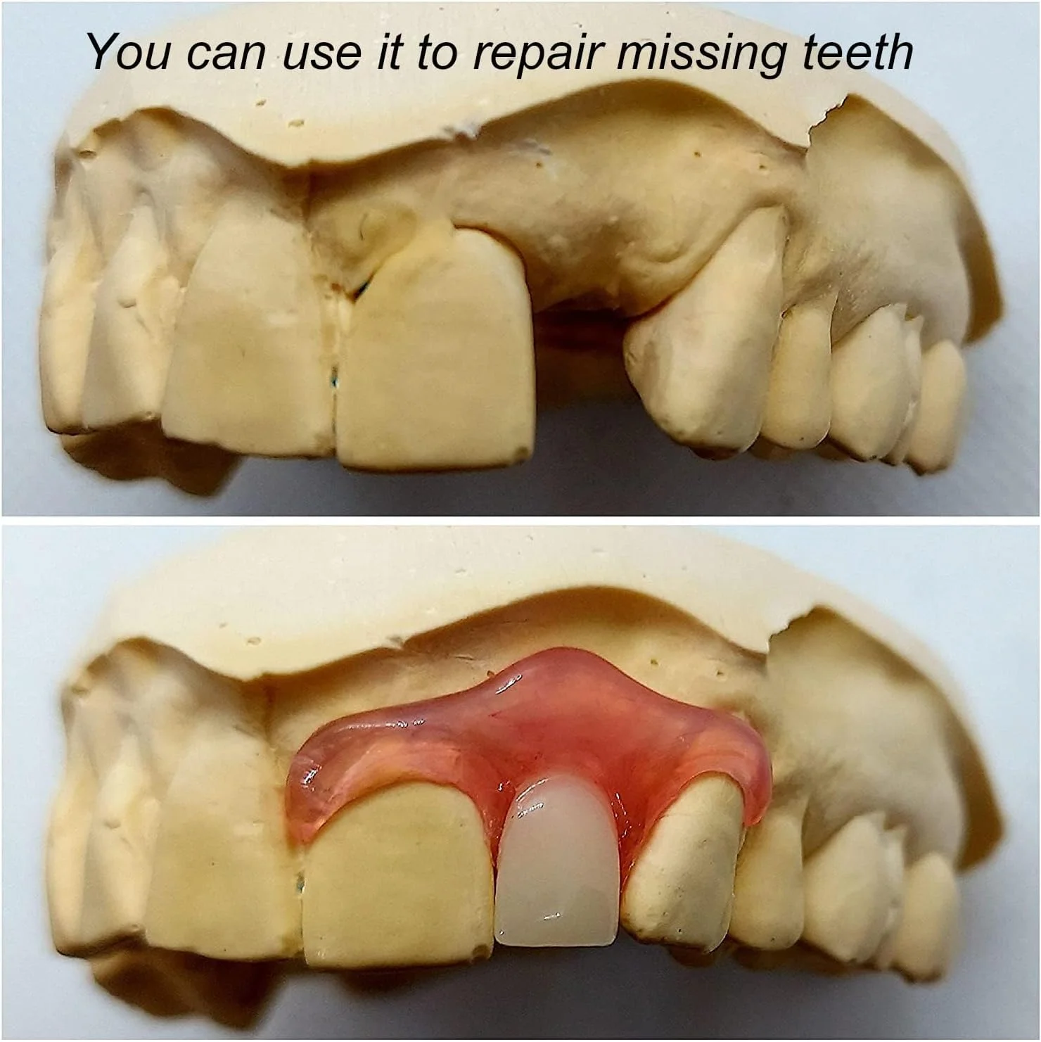 مواد لثه - برای ترمیم دندان های از دست رفته و بهبود لبخند. قطعات پروتزهای جزئی یا کامل