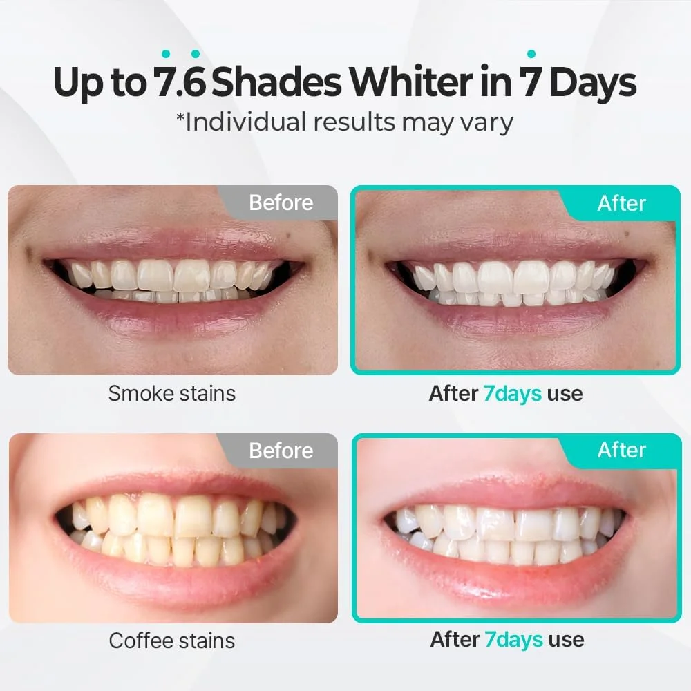 کیت سفید کننده دندان Live Orals PureDia - مجموعه ژل و محافظ دهان، پراکسید هیدروژن، فرموله شده توسط دندانپزشک برای دندان های حساس، 28 بار استفاده.