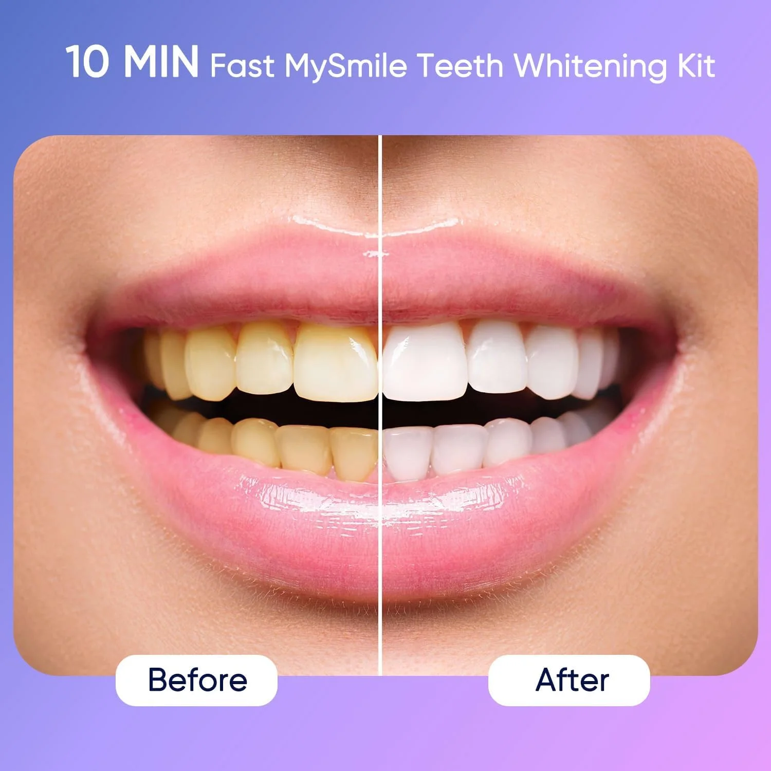 کیت سفید کننده دندان MySmile Deluxe با نور 28 LED و ژل سفید کننده دندان 35% کاربامید پراکسید، کمک به از بین بردن لکه های ناشی از قهوه، نوشابه، آبمیوه و غذا کیت سفید کننده دندان MySmile Deluxe با نور 28 LED و ژل سفید کننده دندان 35% کاربامید پراکسید، کمک به از بین بردن لکه های ناشی از قهوه، نوشابه، آبمیوه و غذا